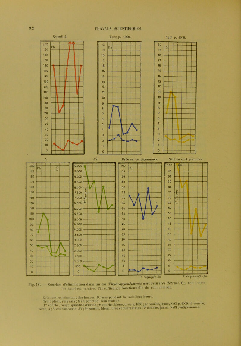 Quantité. Urée p. 1000. Na Cl p. 1000. Fig. 18. — Courbes d'élimination dans un cas d’hydropyonéphrosc avec rein très détruit. On \oil toutes les courbes montrer l'insuffisance fonctionnelle du rein malade. Colonnes représentant des heures. Boisson pendant la troisième heure. Trait plein, rein sain ; trait ponctué, rein malade. 1» courbe, rouge, quantité d’urine;2’ courbe, bleue,urée p. 1000 ; 3* courbe,jaune,NaC p. 1000; l courbe, verte, A ; 5- courbe, verte, AV ; 6* courbe, bleue, urée centigrammes ; 7* courbe, jaune, Nabi centigrammes.