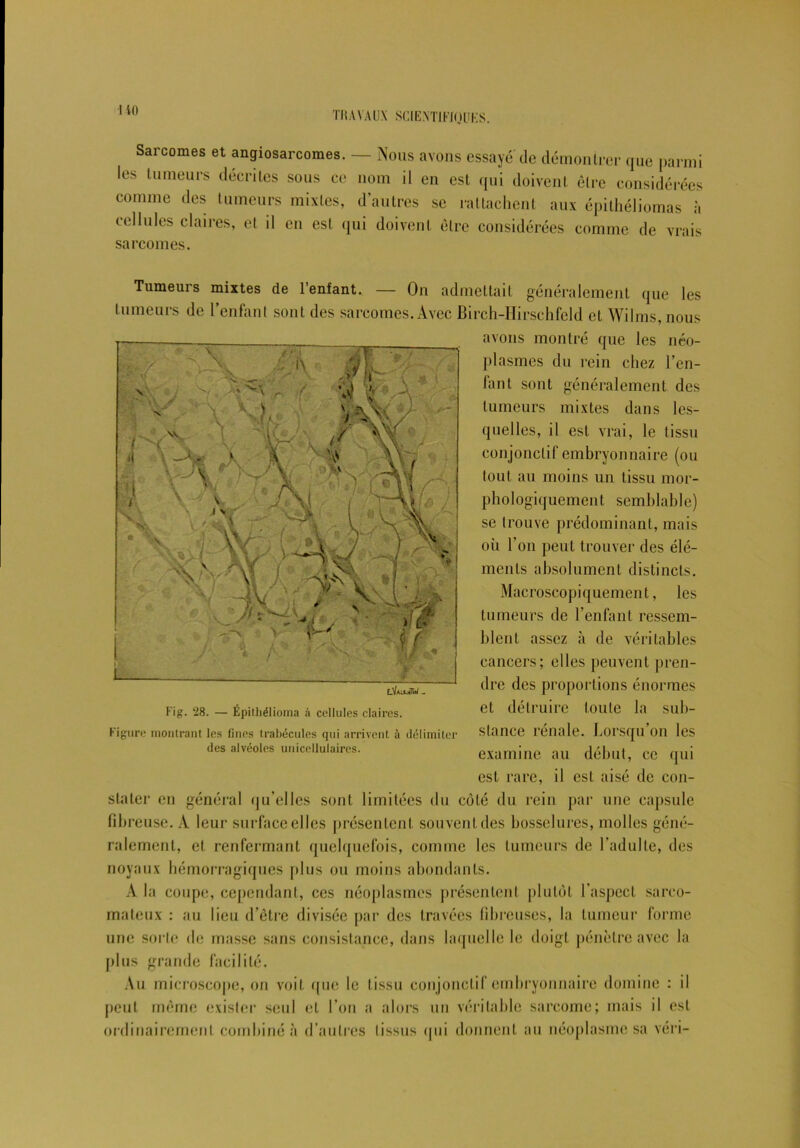 I io Sarcomes et angiosarcomes. — Nous avons essayé de démontrer que parmi les tumeurs décrites sous ce nom il en est qui doivent être considérées comme des tumeurs mixtes, d’autres se rattachent aux épithéliomas à cellules claires, et il en est qui doivent être considérées comme de vrais sarcomes. Tumeurs mixtes de l’enfant. — On admettait généralement que les tumeurs de l’enfant sont des sarcomes.Avec Birch-Hirschfeld et Wilms, nous avons montré que les néo- plasmes du rein chez l’en- fant sont généralement des tumeurs mixtes dans les- quelles, il est vrai, le tissu conjonctif embryonnaire (ou tout au moins un tissu mor- phologiquement semblable) se trouve prédominant, mais où l’on peut trouver des élé- ments absolument distincts. Macroscopiquement, les tumeurs de l’enfant ressem- blent assez à de véritables cancers; elles peuvent pren- dre des proportions énormes et détruire toute la sub- stance rénale. Lorsqu’on les examine au début, ce qui est rare, il est aisé de con- stater en général qu’elles sont limitées du côté du rein par une capsule fibreuse. A leur surface elles présentent souvent des bosselures, molles géné- ralement, et renfermant quelquefois, comme les tumeurs de l’adulte, des noyaux hémorragiques plus ou moins abondants. A la coupe, cependant, ces néoplasmes présentent plutôt l’aspect sarco- mateux : au lieu d’être divisée par des travées fibreuses, la tumeur forme une sorte de masse sans consistance, dans laquelle le doigt pénètre avec la plus grande facilité. Au microscope, on voit que le tissu conjonctif embryonnaire domine : il peut même exister seul et l’on a alors un véritable sarcome; mais il est ordinairement combiné à d’autres tissus qui donnent au néoplasme sa véri- Fig. 28. — Épithélioma à cellules claires. Figure montrant les fines trabécules qui arrivent à délimiter des alvéoles unicellulaires.