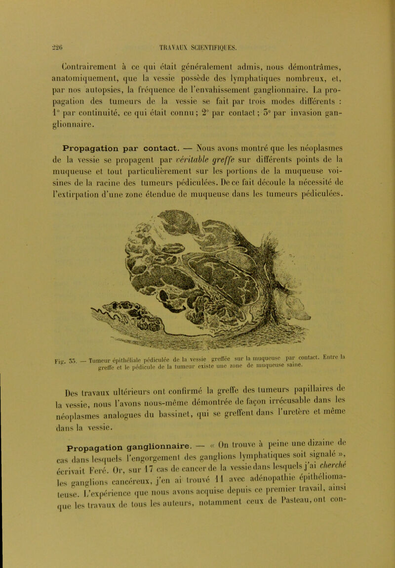 Contrairement à ce qui était généralement admis, nous démontrâmes, anatomiquement, que la vessie possède des lymphatiques nombreux, et, par nos autopsies, la fréquence de l’envahissement ganglionnaire. La pro- pagation des tumeurs de la vessie se fait par trois modes différents : 1° par continuité, ce qui était connu; 2° par contact ; 5° par invasion gan- glionnaire. Propagation par contact. — Nous avons montré que les néoplasmes de la vessie se propagent par véritable greffe sur différents points de la muqueuse et tout particulièrement sur les portions de la muqueuse voi- sines de la racine des tumeurs pédiculées. De ce fait découle la nécessité de l’extirpation d’une zone étendue de muqueuse dans les tumeurs pédiculées. Fi-. 55 - Tumeur épithéliale pédiculée de la vessie greffée sur la muqueuse par contact. Entre la greffe et le pédicule de la tumeur existe une zone de muqueuse saine. Des travaux ultérieurs ont confirmé la greffe des tumeurs papillaires de la vessie, nous l’avons nous-même démontrée de façon irrécusable dans les néoplasmes analogues du bassinet, qui se greffent dans 1 uretere et meme dans la vessie. Propagation ganglionnaire. — « On trouve à peine une dizaine de cas dans lesquels l’engorgement des ganglions lymphatiques soit signale », écrivait Feré. Or, sur 17 cas de cancer de la vessie dans lesquels j ai cherche les ganglions cancéreux, j’en ai trouvé 11 avec adénopathie épilhélioma- leuse. I,'expérience que nous avons acquise depuis ce premier travail, ainsi que les travaux de tous les auteurs, notamment ceux de Pasteau, ont cou-