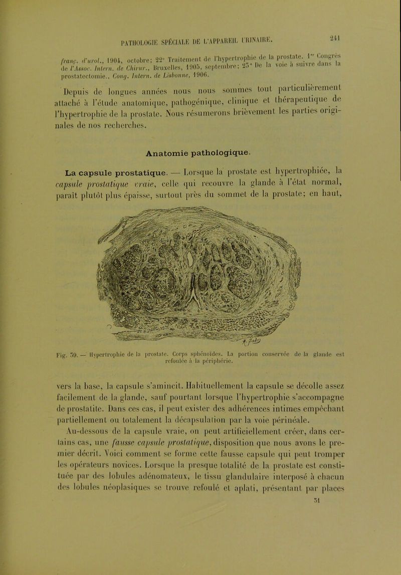 franç. d'uroL, 1904, octobre; 22“ Traitement de l’hypertrophie de la prostate 1 Congcês de l'Assoc. Inteni. de China-., Bruxelles, 1905, septembre; 2.:>“ De la voie a suivre te ■ < prostatectomie., Cotuj. Intern. de Lisbonne, 1900. Depuis de longues années nous nous sommes tout pat liculièrement attaché à l’étude anatomique, pathogénique, clinique et thérapeutique de l’hypertrophie de ht prostate. Nous résumerons brièvement les pot lies ot ini- tiales de nos recherches. Anatomie pathologique. La capsule prostatique. — Lorsque la prostate est hypertrophiée, la capsule prostatique vraie, celle qui recouvre la glande a I état normal, paraît plutôt plus épaisse, surtout près du sommet de la prostate; en haut, Fig. 59. — Hypertrophie de la prostate. Corps sphénoïdes. La portion conservée de la glande est refoulée à la périphérie. vers la hase, la capsule s’amincit. Habituellement la capsule se décolle assez facilement de la glande, sauf pourtant lorsque l’hypertrophie s’accompagne de prostatite. Dans ces cas, il peut exister des adhérences intimes empêchant partiellement ou totalement la déenpsulalion par la voie périnéale. Au-dessous de ht capsule vraie, on peut artificiellement créer, dans cer- tains cas, une fausse capsule prostatique, disposition que nous avons le pre- mier décrit. Voici comment se forme celle fausse capsule qui peut tromper les opérateurs novices. Lorsque la presque totalité de la prostate est consti- tuée par des lobules adénomateux, le tissu glandulaire interposé à chacun des lobules néoplasiques se trouve refoulé et aplati, présentant par places 51