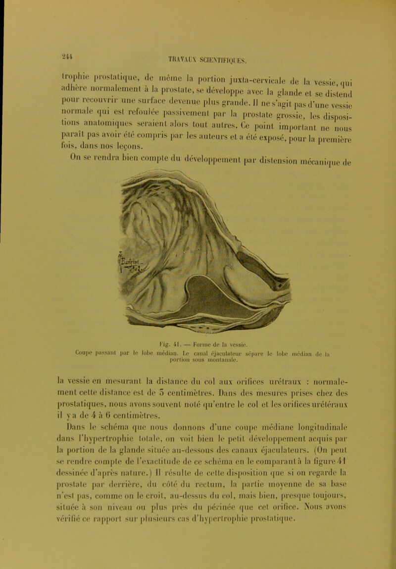 trophie prostatique, de même la portion juxta-cervicale de la vessie oui adhéré normalement a la prostate, se développe avec la glande et se distend pour recouvrir une surface devenue plus grande. Il ne s’agit pas d’une vessie normale qui est refoulée passivement par la prostate grossie, les disposi- tions anatomiques seraient alors tout autres. Ce point important ne nous paraît pas avoir été compris par les auteurs et a été exposé, pour la première fois, dans nos leçons. On se rendra bien compte du développement par distension mécanique de Fig. 41. — Forme de In vessie. Coupe passant par le lobe médian. Le canal éjaculateur sépare le lobe médian de la portion sous montanale. la vessie en mesurant la distance du col aux orifices urétraux : normale- ment celte distance est de 5 centimètres. Dans des mesures prises chez des prostatiques, nous avons souvent noté qu’entre le col et les orifices urétéraux il va de 4 à 0 centimètres. «J Dans le schéma que nous donnons d’une coupe médiane longitudinale dans l'hypertrophie totale, on voit bien le petit développement acquis par la portion de la glande située au-dessous des canaux éjaeulaleurs. (On peut se rendre compte de l’exactitude de ce schéma en le comparant à la figure41 dessinée d’après nature.) Il résulte de cette disposition (pie si on regarde la prostate par derrière, du côté du rectum, la partie moyenne de sa base n’est pas, comme on le croit, au-dessus du col, mais bien, presque toujours, située à son niveau ou plus près du périnée que cet orifice. Nous avons vérifié ce rapport sur plusieurs cas d’hypertrophie prostatique.