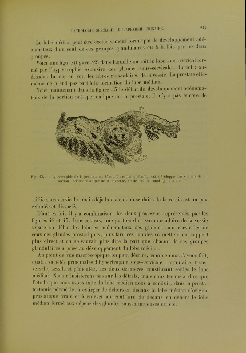 Le lobe médian peut être exclusivement formé par le développement adé- nomateux d’un seul de ces groupes glandulaires ou a la lois par les deux groupes. Voici une ligure (ligure 42) dans laquelle on voit le lobe sous-cervical lor- mé par l’hypertrophie exclusive des glandes sous-cervicales du col . au- dessous du lobe on voit les libres musculaires de la vessie. La prostate elle- même ne prend pas parla la formation du lobe médian. Voici maintenant dans la figure 45 le début du développement adénoma- teux de la portion pré-spermatique de la prostate. 11 n y a pas encore de Fig. 43. — Hypertrophie de hi prostate au début. Un corps sphénoïde est développé aux dépens de la portion pré-spermatique de la prostate, au-dessus du canal éjaculateur. saillie sous-cervicale, mais déjà la couche musculaire de la vessie est un peu refoulée et dissociée. D’autres fois il y a combinaison des deux processus représentés par les figures 42 et 45. Dans ces cas, une portion du tissu musculaire de la vessie sépare au début les lobules adénomateux des glandes sous-cervicales de ceux des glandes prostatiques; plus tard ces lobules se mettent en rapport plus direct et on ne saurait plus dire la part que chacun de ces groupes glandulaires a prise au développement du lobe médian. Au point de vue macroscopique on peut décrire, comme nous l’avons fait, quatre variétés principales d’hypertrophie sous-cervicale : annulaire, trans- versale, sessile et pédiculée, ces deux dernières constituant seules le lobe médian. Nous n’insisterons pas sur les détails, mais nous tenons à dire que l’étude que nous avons faite du lobe médian nous a conduit, dans la prosta- tectomie périnéale, a extirper de dehors en dedans le lobe médian d’origine prostatique vraie et à enlever au contraire de dedans en dehors le lobe médian formé aux dépens des glandes sous-muqueuses du col.