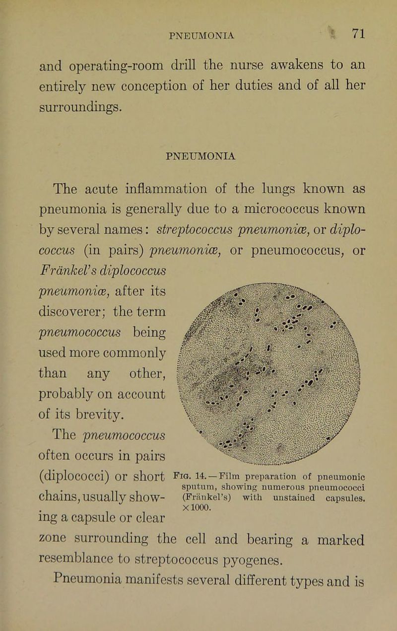 and operating-room drill the nurse awakens to an entirely new conception of her duties and of all her surroundings. PNEUMONIA The acute inflammation of the lungs known as pneumonia is generally due to a micrococcus known by several names: streptococcus pneumonice, or diplo- coccus (in pairs) pneumonice, or pneumococcus, or Frankers diplococcus pneumonice, after its discoverer; the term pneumococcus being used more commonly than any other, probably on account of its brevity. The pneumococcus often occurs in pairs (diplococci) or short 14. —Film preparation of pneumonic sputum, showing numerous pneumococci chains, usually show- (Friinkel’s) with unstained capsules. XlOOO. mg a capsule or clear zone surrounding the cell and bearing a marked resemblance to streptococcus pyogenes. Pneumonia manifests several different types and is