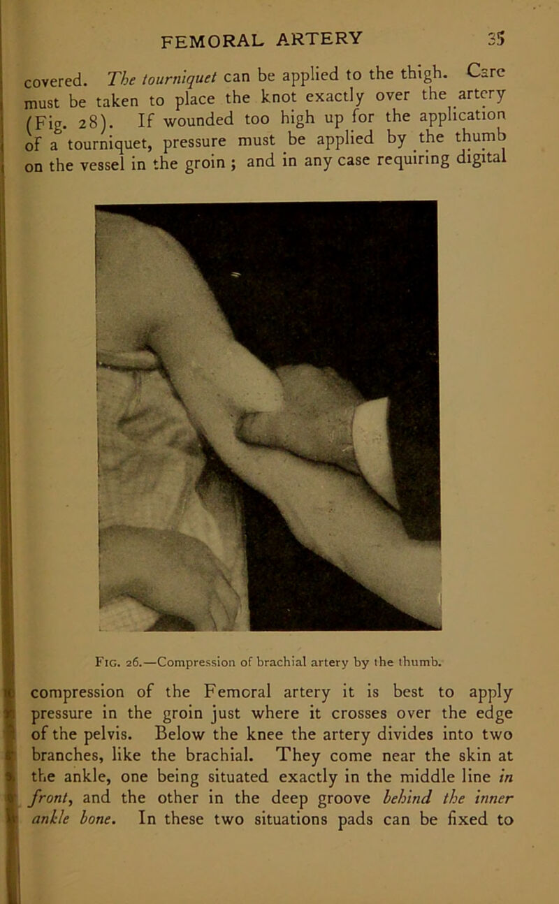 covered. The tourniquet can be applied to the thigh. Care must be taken to place the knot exactly over the artery (Fig. 28). If wounded too high up for the application of a& tourniquet, pressure must .be applied by the thumb on the vessel in the groin ; and in any case requiring digital Fig. 26.—Compression of brachial artery by the thumb. compression of the Femoral artery it is best to apply pressure in the groin just where it crosses over the edge of the pelvis. Below the knee the artery divides into two branches, like the brachial. They come near the skin at the ankle, one being situated exactly in the middle line in front, and the other in the deep groove behind the Inner ankle bone. In these two situations pads can be fixed to