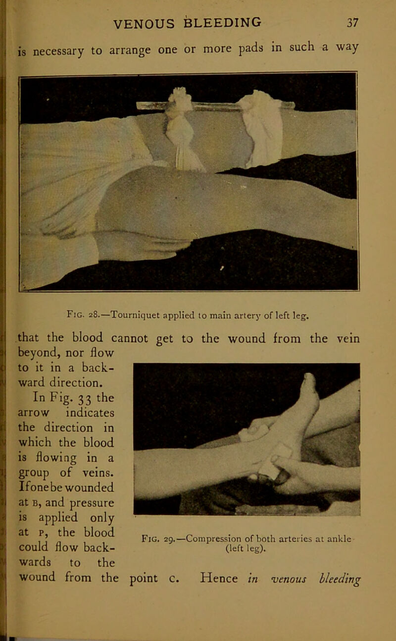 is necessary to arrange one or more pads in such a way Fig. 28.—Tourniquet applied to main artery ofleft leg. that the blood cannot get to the wound from the vein beyond, nor flow to it in a back- ward direction. In Fig. 33 the arrow indicates the direction in which the blood is flowing in a group of veins. Ifonebewounded at b, and pressure is applied only at p, the blood could flow back- wards to the wound from the point c. Hence in venous bleeding Fig. 29.—Compression of both arteries at ankle (left leg).