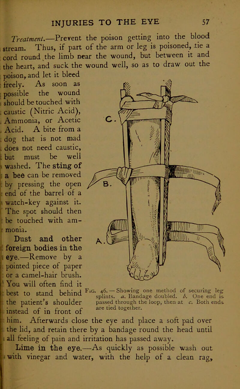 Treatment.—Prevent the poison getting into the blood stream. Thus, if part of the arm or leg is poisoned, .tie a cord round the limb near the wound, but between it and the heart, and suck the wound well, so as to draw out the poison, and let it bleed : freely. As soon as : possible the wound - should be touched with caustic (Nitric Acid), Ammonia, or Acetic . Acid. A bite from a dog that is not mad . does not need caustic, t but must be well , washed. The sting of a bee can be removed by pressing the open end of the barrel of a watch-key against it. The spot should then be touched with am- monia. Dust and other foreign bodies in the eye.—Remove by a pointed piece of paper or a camel-hair brush. You will often find it hest tn ctpnrl hehinH F,G- A — Showing one method of securing leg Dest to Stand Demna spljnts. a. Bandage doubled, b. One end is the patient’s shoulder passed through the loop, then at c. Both ends j r • r ^ r are tied together. instead of in front of him. Afterwards close the eye and place a soft pad over : the lid, and retain there by a bandage round the head until all feeling of pain and irritation has passed away. Lime in the eye.—As quickly as possible wash out * with vinegar and water, with the help of a clean rag.