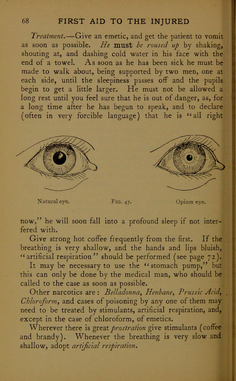 Treatment.—Give an emetic, and get the patient to vomit as soon as possible. He must be roused up by shaking, shouting at, and dashing cold water in his face with the end of a towel. As soon as he has been sick he must be made to walk about, being supported by two men, one at each side, until the sleepiness passes off and the pupils begin to get a little larger. He must not be allowed a long rest until you feel sure that he is out of danger, as, for a long time after he has begun to speak, and to declare (often in very forcible language) that he is “all right Natural eye. Fig. 47. Opium eye. now,” he will soon fall into a profound sleep if not inter- fered with. Give strong hot coffee frequently from the first. If the breathing is very shallow, and the hands and lips bluish, “artificial respiration” should be performed (see page 72). It may be necessary to use the “stomach pump,” but this can only be done by the medical man, who should be called to the case as soon as possible. Other narcotics are : Belladonna, Henbane, Prussic Acid, . Chloroform, and cases of poisoning by any one of them may need to be treated by stimulants, artificial respiration, and, except in the case of chloroform, of emetics. Wherever there is great prostration give stimulants (coffee and brandy). Whenever the breathing is very slow and shallow, adopt artificial respiration.
