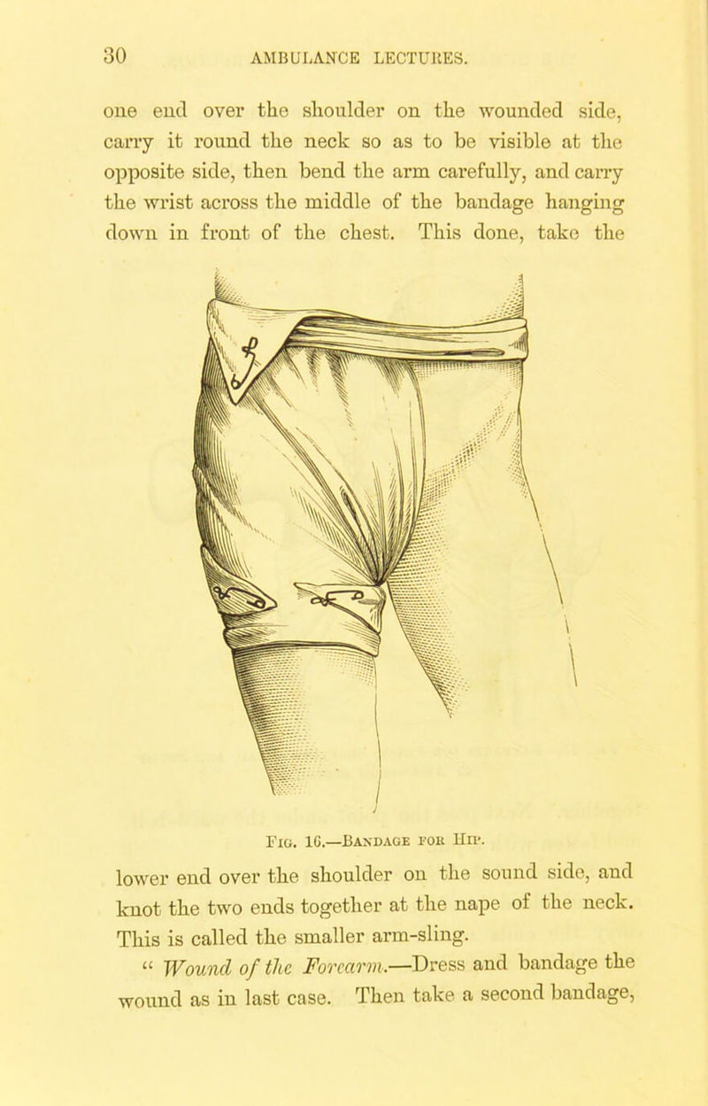 one end ovei’ the shoulder on the wounded side, carry it round the neck so as to be visible at the opposite side, then bend the arm carefully, and carry the wrist across the middle of the bandage hanging down in front of the chest. This done, take the Fig. 1G.—Bandage for Hid. lower end over the shoulder on the sound side, and knot the two ends together at the nape of the neck. This is called the smaller arm-sling. “ Wound of the Forearm,—Dress and bandage the wound as in last case. Then take a second bandage,