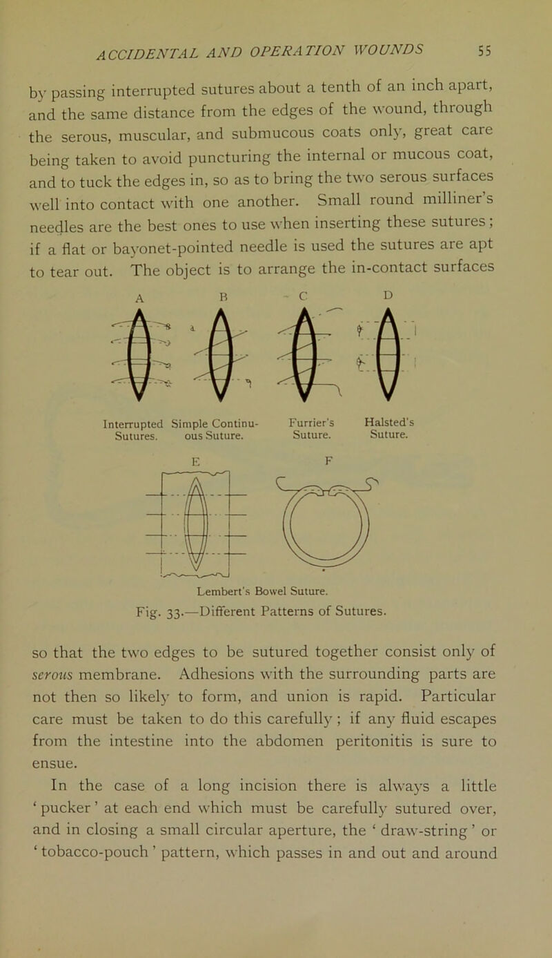by passing interrupted sutures about a tenth of an inch apart, and the same distance from the edges of the wound, through the serous, muscular, and submucous coats only, great caie being taken to avoid puncturing the internal or mucous coat, and to tuck the edges in, so as to bring the two serous surfaces well into contact with one another. Small round milliner s needles are the best ones to use when inserting these sutures ; if a flat or bayonet-pointed needle is used the sutures are apt to tear out. The object is to arrange the in-contact surfaces Interrupted Simple Continu- Sutures. ous Suture. Furrier's Halsted's Suture. Suture. E F Lembert's Bowel Suture. Fig- 33-—Different Patterns of Sutures. so that the two edges to be sutured together consist only of serous membrane. Adhesions with the surrounding parts are not then so likely to form, and union is rapid. Particular care must be taken to do this carefully; if any fluid escapes from the intestine into the abdomen peritonitis is sure to ensue. In the case of a long incision there is always a little ‘ pucker ’ at each end which must be carefully sutured over, and in closing a small circular aperture, the ‘ draw-string ’ or ‘tobacco-pouch’ pattern, which passes in and out and around