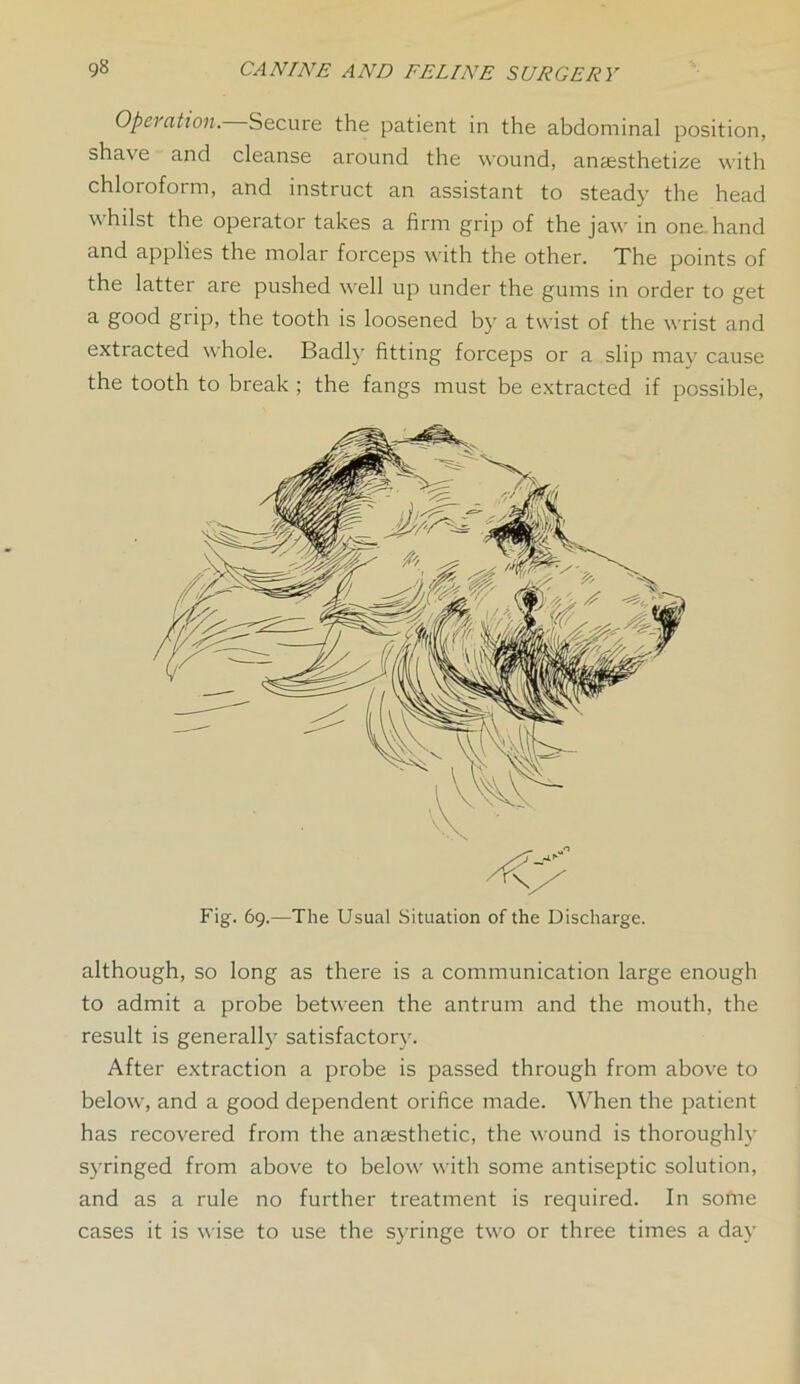 Operation. Secure the patient in the abdominal position, shave and cleanse around the wound, anaesthetize with chloroform, and instruct an assistant to steady the head whilst the operator takes a firm grip of the jaw in one.hand and applies the molar forceps with the other. The points of the latter are pushed well up under the gums in order to get a good grip, the tooth is loosened by a twist of the wrist and extracted whole. Badly fitting forceps or a slip may cause the tooth to break ; the fangs must be extracted if possible, Fig. 69.—The Usual Situation of the Discharge. although, so long as there is a communication large enough to admit a probe between the antrum and the mouth, the result is generally satisfactory. After extraction a probe is passed through from above to below, and a good dependent orifice made. When the patient has recovered from the anaisthetic, the wound is thoroughly syringed from above to below with some antiseptic solution, and as a rule no further treatment is required. In sofne cases it is wise to use the syringe two or three times a day