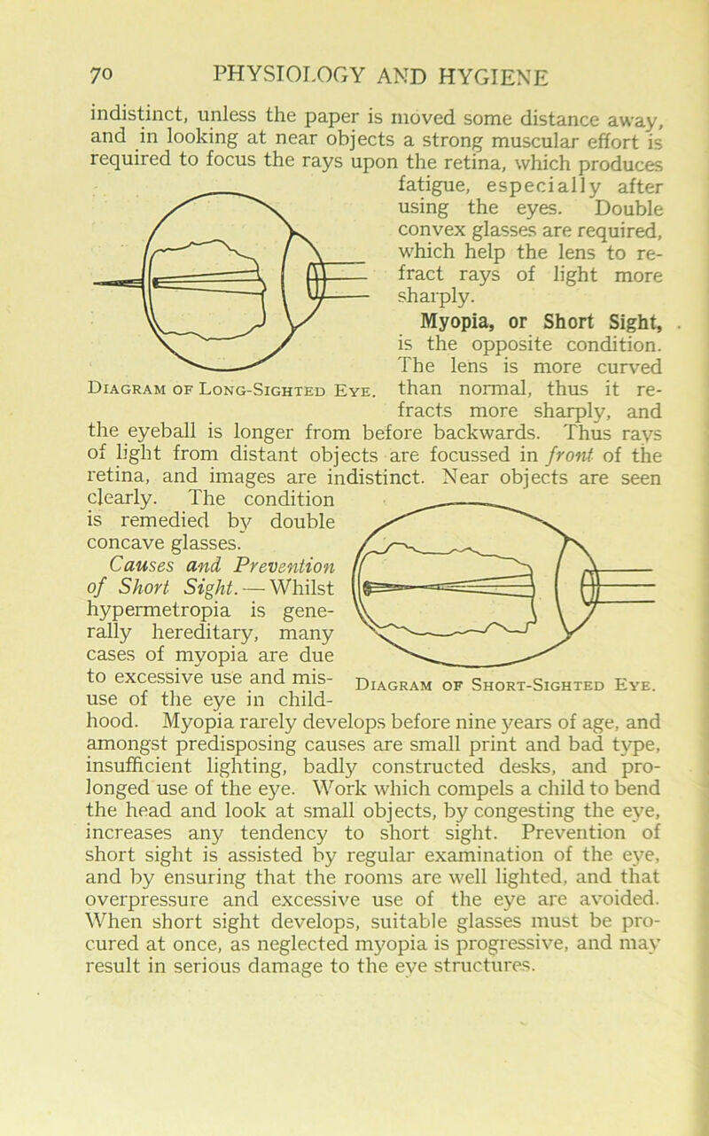 Diagram of Long-Sighted Eye. indistinct, unless the paper is moved some distance away, and in looking at near objects a strong muscular effort is required to focus the rays upon the retina, which produces fatigue, especially after using the eyes. Double convex glasses are required, which help the lens to re- fract rays of light more sharply. Myopia, or Short Sight, is the opposite condition. The lens is more curved than normal, thus it re- fracts more sharply, and the eyeball is longer from before backwards. Thus rays of light from distant objects are focussed in front of the retina, and images are indistinct. Near objects are seen clearly. The condition is remedied by double concave glasses. Causes and Prevention of Short Sight. — Whilst hypermetropia is gene- rally hereditary, many cases of myopia are due to excessive use and mis- use of the eye in child- hood. Myopia rarely develops before nine years of age, and amongst predisposing causes are small print and bad type, insufficient lighting, badly constructed desks, and pro- longed use of the eye. Work which compels a child to bend the head and look at small objects, by congesting the eye, increases any tendency to short sight. Prevention of short sight is assisted by regular examination of the ej^e, and by ensuring that the rooms are well lighted, and that overpressure and excessive use of the eye are avoided. When short sight develops, suitable glasses must be pro- cured at once, as neglected myopia is progressive, and may result in serious damage to the eye structures.