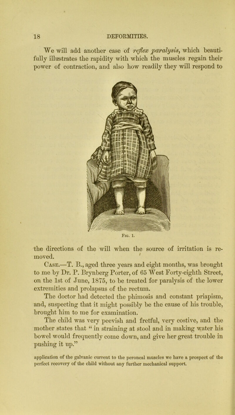 We will add another case of reflex paralysis, which beauti- fully illustrates the rapidity with which the muscles regain their power of contraction, and also how readily they will respond to Fig. 1. the directions of the will wrhen the source of irritation is re- moved. Case.—T. B., aged three years and eight months, was brought to me by Dr. P. Brynberg Porter, of 65 West Forty-eighth Street, on the 1st of June, 18Y5, to be treated for paralysis of the lower extremities and prolapsus of the rectum. The doctor had detected the phimosis and constant priapism, and, suspecting that it might possibly be the cause of his trouble, brought him to me for examination. The child was very peevish and fretful, very costive, and the mother states that “ in straining at stool and in making water his bowel would frequently come down, and give her great trouble in pushing it up.” application of the galvanic current to the peroneal muscles we have a prospect of the perfect recovery of the child without any further mechanical support.