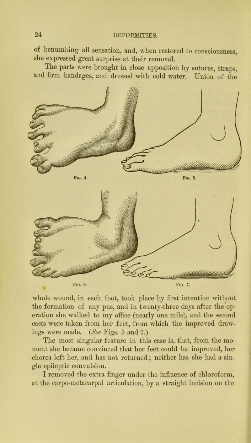 of benumbing all sensation, and, when restored to consciousness, sbe expressed great surprise at tbeir removal. The parts were brought in close apposition by sutures, straps, and firm bandages, and dressed with cold water. Union of the Fig. 4. Fig. 5. Fig. 6. Fig, 7. whole wound, in each foot, took place by first intention without the formation of any pus, and in twenty-three days after the op- eration she walked to my office (nearly one mile), and the second casts were taken from her feet, from which the improved draw- ings were made. (See Figs. 5 and 7.) The most singular feature in this case is, that, from the mo- ment she became convinced that her feet could be improved, her chorea left her, and has not returned; neither has she had a sin- gle epileptic convulsion. I removed the extra finger under the influence of chloroform, at the carpo-metacarpal articulation, by a straight incision on the