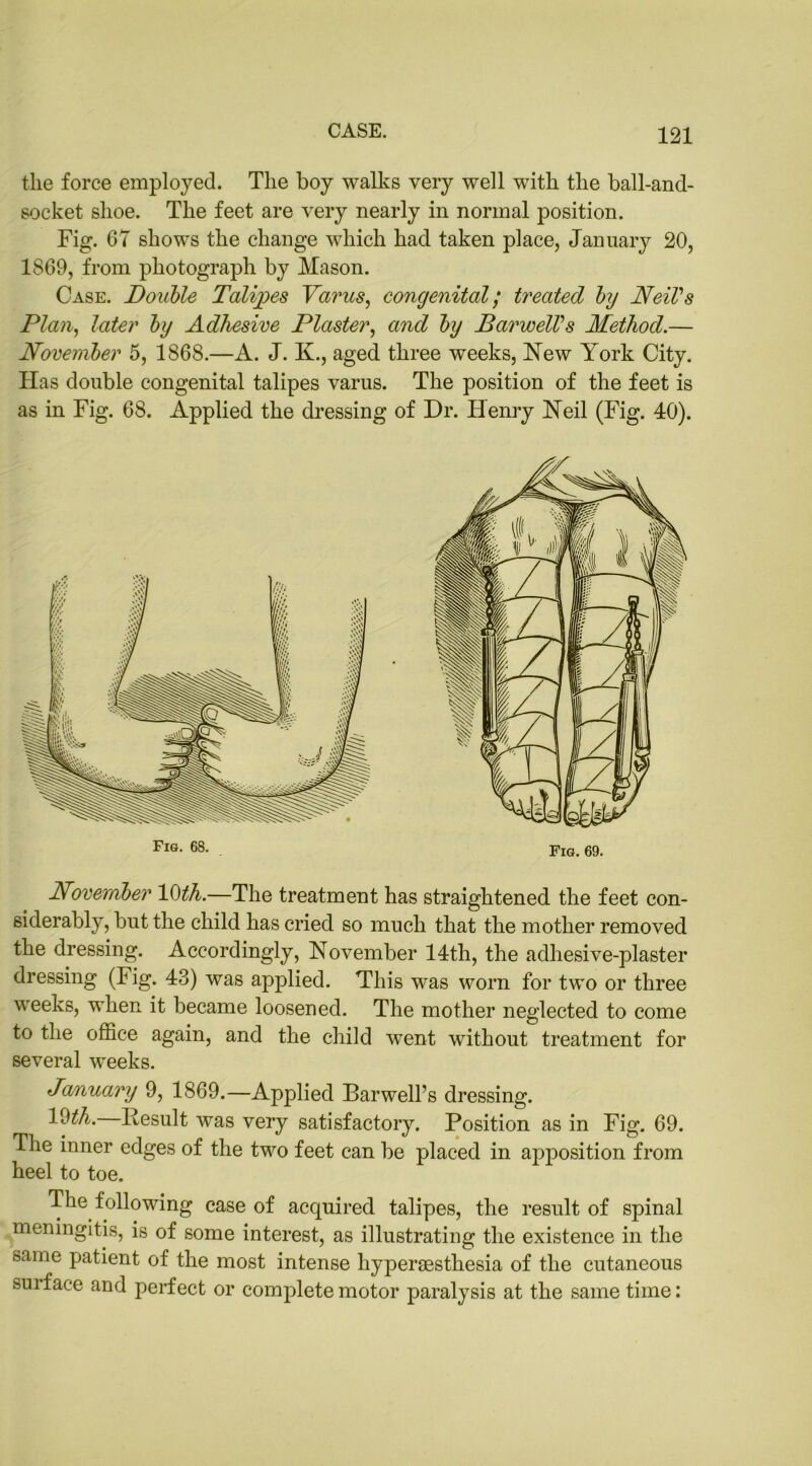 the force employed. The boy walks very well with the ball-and- socket shoe. The feet are very nearly in normal position. Fig. 67 shows the change which had taken place, January 20, 1869, from photograph by Mason. Case. Double Talipes Varus, congenital; treated by Neil's Plan, later by Adhesive Plaster, and by BarwelVs Method.— November 5, 1868.—A. J. K., aged three weeks, New York City. Has double congenital talipes varus. The position of the feet is as in Fig. 68. Applied the dressing of Dr. Henry Neil (Fig. 40). Novernber 10th.—The treatment has straightened the feet con- siderably, but the child has cried so much that the mother removed the dressing. Accordingly, November 14th, the adhesive-plaster dressing (Fig. 43) was applied. This was worn for two or three weeks, when it became loosened. The mother neglected to come to the office again, and the child went without treatment for several weeks. January 9, 1869.—Applied Barwell’s dressing. 10th. Result was very satisfactory. Position as in Fig. 69. The inner edges of the two feet can be placed in apposition from heel to toe. The following case of acquired talipes, the result of spinal meningitis, is of some interest, as illustrating the existence in the name patient of the most intense hypersesthesia of the cutaneous suiface and perfect or complete motor paralysis at the same time: