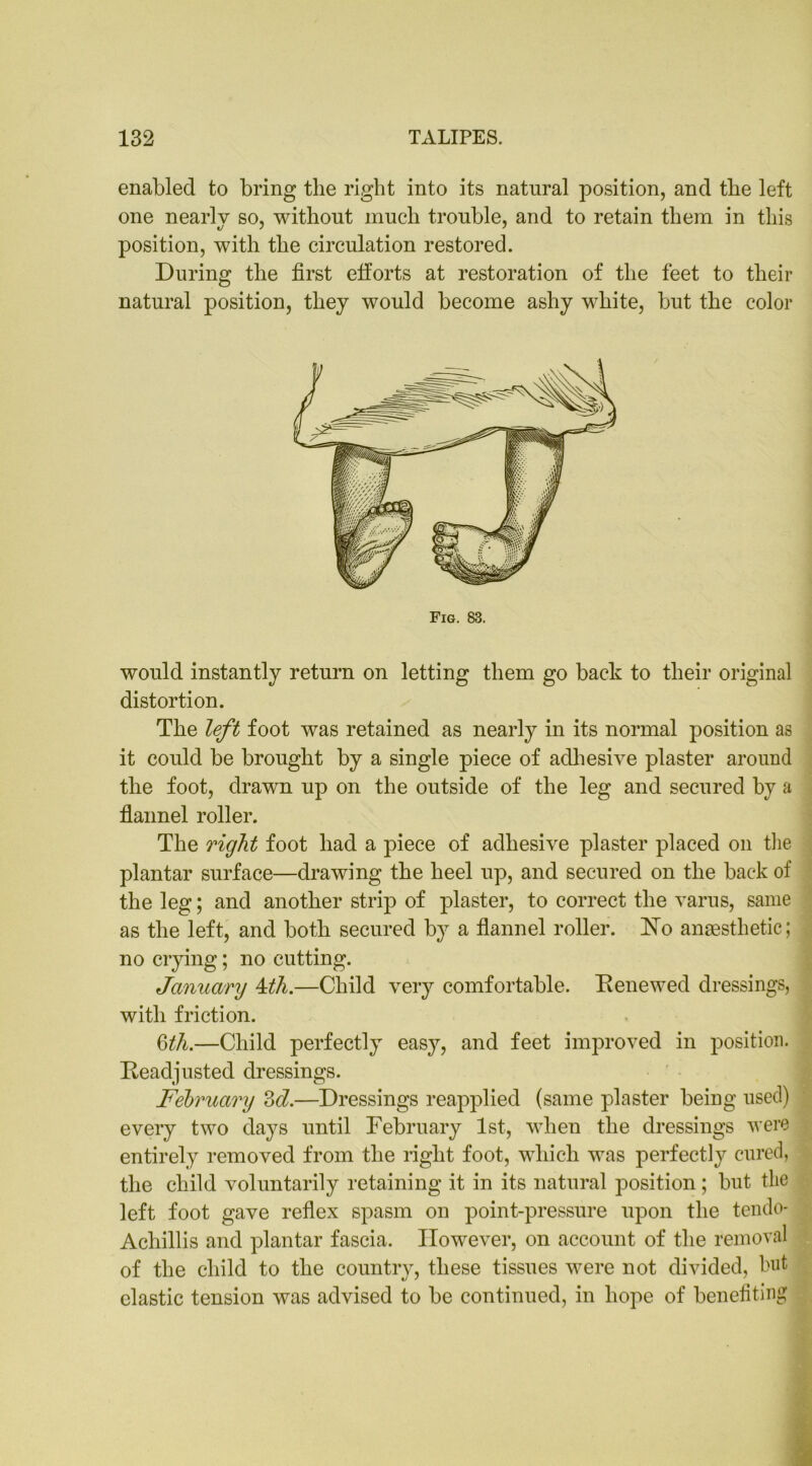 enabled to bring the right into its natural position, and the left one nearly so, without much trouble, and to retain them in this position, with the circulation restored. During the first efforts at restoration of the feet to their natural position, they would become ashy white, but the color Fig. 83. would instantly return on letting them go back to their original distortion. The left foot was retained as nearly in its normal position as it could be brought by a single piece of adhesive plaster around the foot, drawn up on the outside of the leg and secured by a flannel roller. The right foot had a piece of adhesive plaster placed on the plantar surface—drawing the heel up, and secured on the back of the leg; and another strip of plaster, to correct the varus, same as the left, and both secured by a flannel roller. No anaesthetic; no crying; no cutting. January 4dh.—Child very comfortable. Renewed dressings, with friction. Qth.—Child perfectly easy, and feet improved in position. Readjusted dressings. February 3cl.—Dressings reapplied (same plaster being used) every two days until February 1st, when the dressings were entirely removed from the right foot, which was perfectly cured, the child voluntarily retaining it in its natural position; but the left foot gave reflex spasm on point-pressure upon the tendo- Achillis and plantar fascia. However, on account of the removal of the child to the country, these tissues were not divided, hut elastic tension was advised to be continued, in hope of benefiting