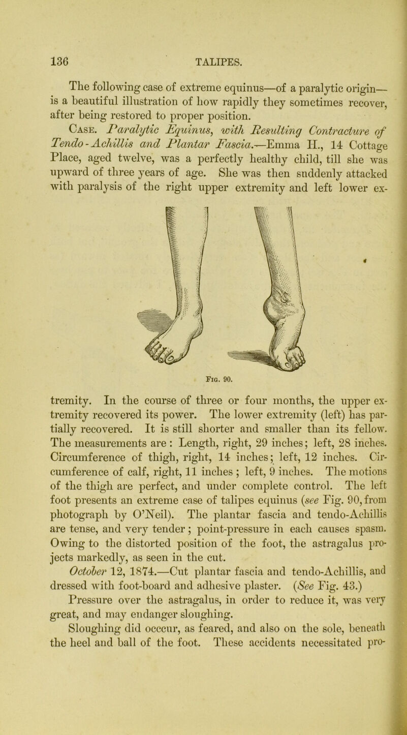 The following case of extreme equinus—of a paralytic origin— is a beautiful illustration of liow rapidly they sometimes recover, after being restored to proper position. Case. Paralytic Fqitinus, with Resulting Contracture of Tenclo - Achillis and Plantar Fascia.-^Emma TL, 11 Cottage Place, aged twelve, was a perfectly healthy child, till she was upward of three years of age. She was then suddenly attacked with paralysis of the right upper extremity and left lower ex- tremity. In the course of three or four months, the upper ex- tremity recovered its power. The lower extremity (left) has par- tially recovered. It is still shorter and smaller than its fellow. The measurements are : Length, right, 29 inches; left, 28 inches. Circumference of thigh, right, 11 inches; left, 12 inches. Cir- cumference of calf, right, 11 inches ; left, 9 inches. The motions of the thigh are perfect, and under complete control. The left foot presents an extreme case of talipes equinus (see Fig. 90, from photograph by O’Neil). The plantar fascia and tendo-Achillis are tense, and very tender; point-pressure in each causes spasm. Owing to the distorted position of the foot, the astragalus pro- jects markedly, as seen in the cut. October 12, 1871.—Cut plantar fascia and tendo-Achillis, and dressed with foot-board and adhesive plaster. {See Fig. 13.) Pressure over the astragalus, in order to reduce it, was very great, and may endanger sloughing. Sloughing did occcur, as feared, and also on the sole, beneath the heel and ball of the foot. These accidents necessitated pro-