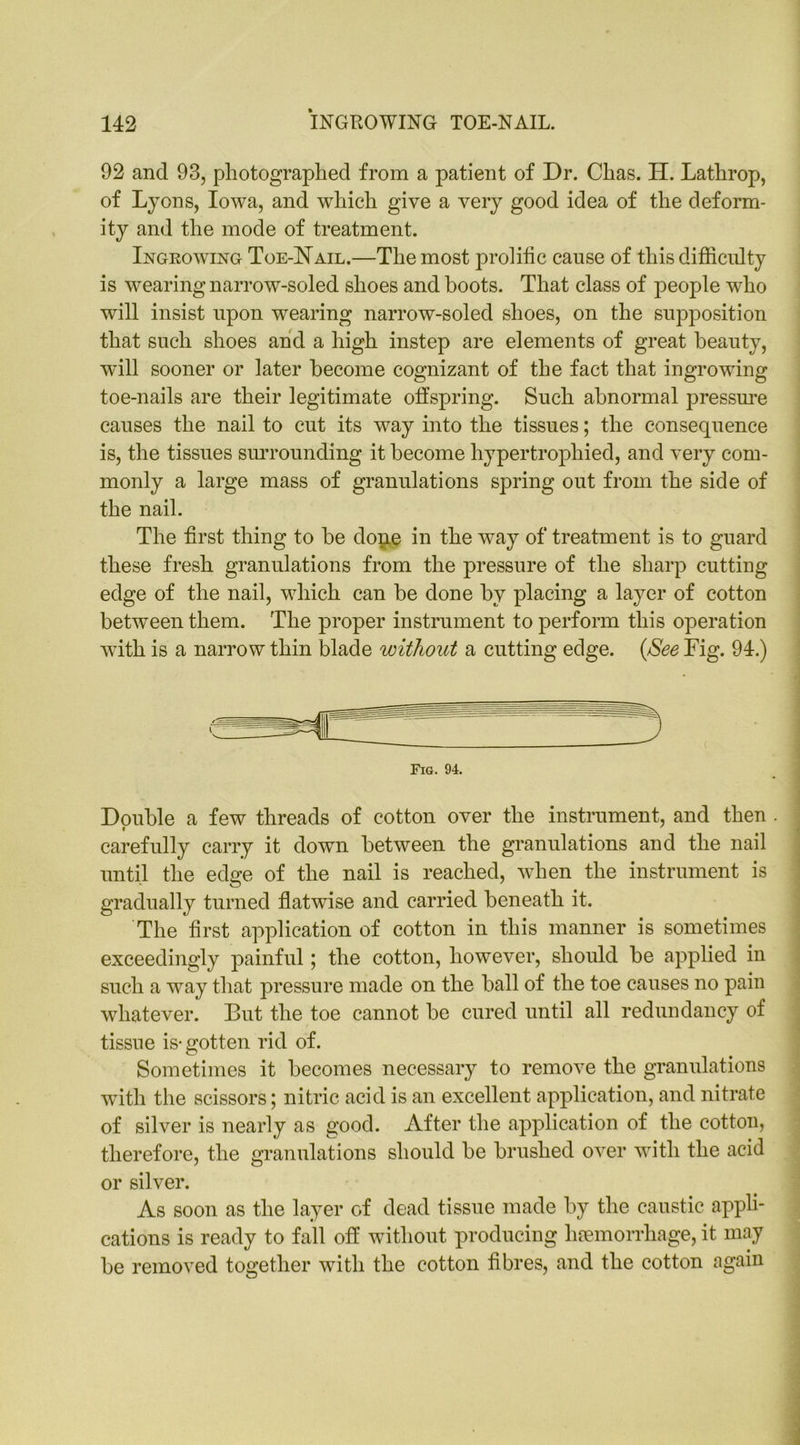 92 and 93, photographed from a patient of Dr. Chas. H. Latlirop, of Lyons, Iowa, and which give a very good idea of the deform- ity and the mode of treatment. Ingkowing Toe-Nail.—The most prolific cause of this difficulty is wearing narrow-soled shoes and boots. That class of people who will insist upon wearing narrow-soled shoes, on the supposition that such shoes and a high instep are elements of great beauty, will sooner or later become cognizant of the fact that ingrowing toe-nails are their legitimate offspring. Such abnormal pressure causes the nail to cut its way into the tissues; the consequence is, the tissues surrounding it become hypertrophied, and very com- monly a large mass of granulations spring out from the side of the nail. The first thing to be done in the wray of treatment is to guard these fresh granulations from the pressure of the sharp cutting edge of the nail, which can be done by placing a layer of cotton between them. The proper instrument to perform this operation with is a narrow thin blade without a cutting edge. {See Fig. 94.) Fig. 94. Double a few threads of cotton over the instrument, and then < carefully carry it down between the granulations and the nail until the edge of the nail is reached, when the instrument is gradually turned flatwise and carried beneath it. The first application of cotton in this manner is sometimes exceedingly painful; the cotton, however, should be applied in such a way that pressure made on the ball of the toe causes no pain whatever. But the toe cannot be cured until all redundancy of tissue is-gotten rid of. Sometimes it becomes necessary to remove the granulations with the scissors; nitric acid is an excellent application, and nitrate of silver is nearly as good. After the application of the cotton, therefore, the granulations should be brushed over with the acid or silver. As soon as the layer of dead tissue made by the caustic appli- cations is ready to fall off without producing haemorrhage, it may be removed together with the cotton fibres, and the cotton again