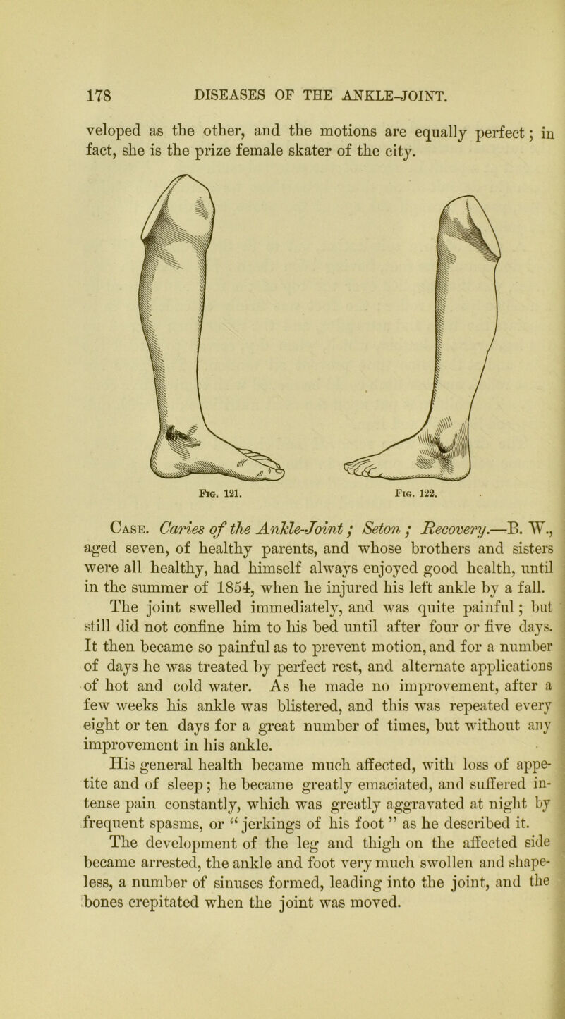 veloped as tlie other, and the motions are equally perfect; in fact, she is the prize female skater of the city. Fig. 121. Fig. 122. Case. Caries of the Ankle-Joint; Seton • Recovery.—B. W., aged seven, of healthy parents, and whose brothers and sisters were all healthy, had himself always enjoyed good health, until in the summer of 1854, when he injured his left ankle by a fall. The joint swelled immediately, and was quite painful; but still did not confine him to his bed until after four or five days. It then became so painful as to prevent motion, and for a number of days he was treated by perfect rest, and alternate applications of hot and cold water. As he made no improvement, after a few weeks his ankle was blistered, and this was repeated every eight or ten days for a great number of times, but without any improvement in his ankle. His general health became much affected, with loss of appe- tite and of sleep; he became greatly emaciated, and suffered in- tense pain constantly, which was greatly aggravated at night by frequent spasms, or a jerkings of his foot ” as he described it. The development of the leg and thigh on the affected side became arrested, the ankle and foot very much swollen and shape- less, a number of sinuses formed, leading into the joint, and the bones crepitated when the joint was moved.