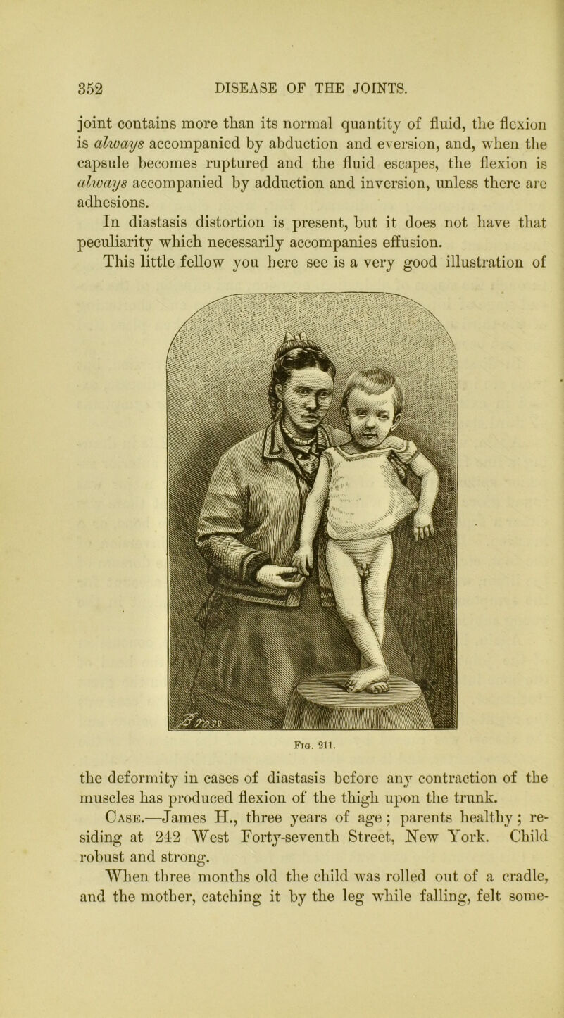 joint contains more tlian its normal quantity of fluid, the flexion is always accompanied by abduction and eversion, and, when the capsule becomes ruptured and the fluid escapes, the flexion is always accompanied by adduction and inversion, unless there are adhesions. In diastasis distortion is present, but it does not have that peculiarity which necessarily accompanies effusion. This little fellow you here see is a very good illustration of Fig. 211. the deformity in cases of diastasis before any contraction of the muscles has produced flexion of the thigh upon the trunk. Case.—James TI., three years of age; parents healthy; re- siding at 242 West Forty-seventh Street, New York. Child robust and strong. When three months old the child was rolled out of a cradle, and the mother, catching it by the leg while falling, felt some-