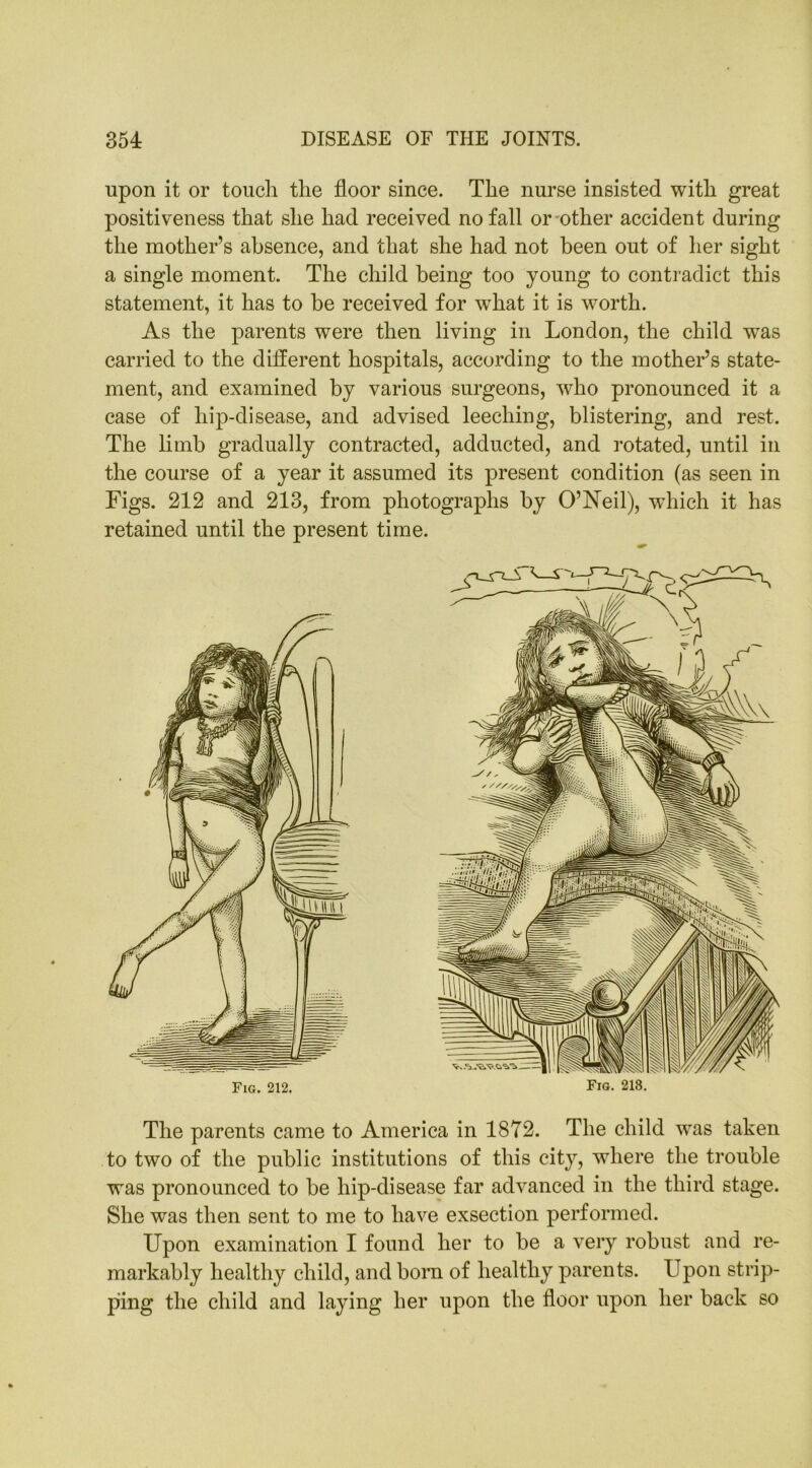 upon it or touch the floor since. The nurse insisted with great positiveness that she had received no fall or other accident during the mother’s absence, and that she had not been out of her sight a single moment. The child being too young to contradict this statement, it has to be received for what it is worth. As the parents were then living in London, the child wras carried to the different hospitals, according to the mother’s state- ment, and examined by various surgeons, who pronounced it a case of hip-disease, and advised leeching, blistering, and rest. The limb gradually contracted, adducted, and rotated, until in the course of a year it assumed its present condition (as seen in Figs. 212 and 213, from photographs by O’Neil), which it has retained until the present time. Fig. 212. Fig. 218. The parents came to America in 1872. The child was taken to two of the public institutions of this city, where the trouble was pronounced to be hip-disease far advanced in the third stage. She was then sent to me to have exsection performed. Upon examination I found her to be a very robust and re- markably healthy child, and born of healthy parents. Upon strip- ping the child and laying her upon the floor upon her back so
