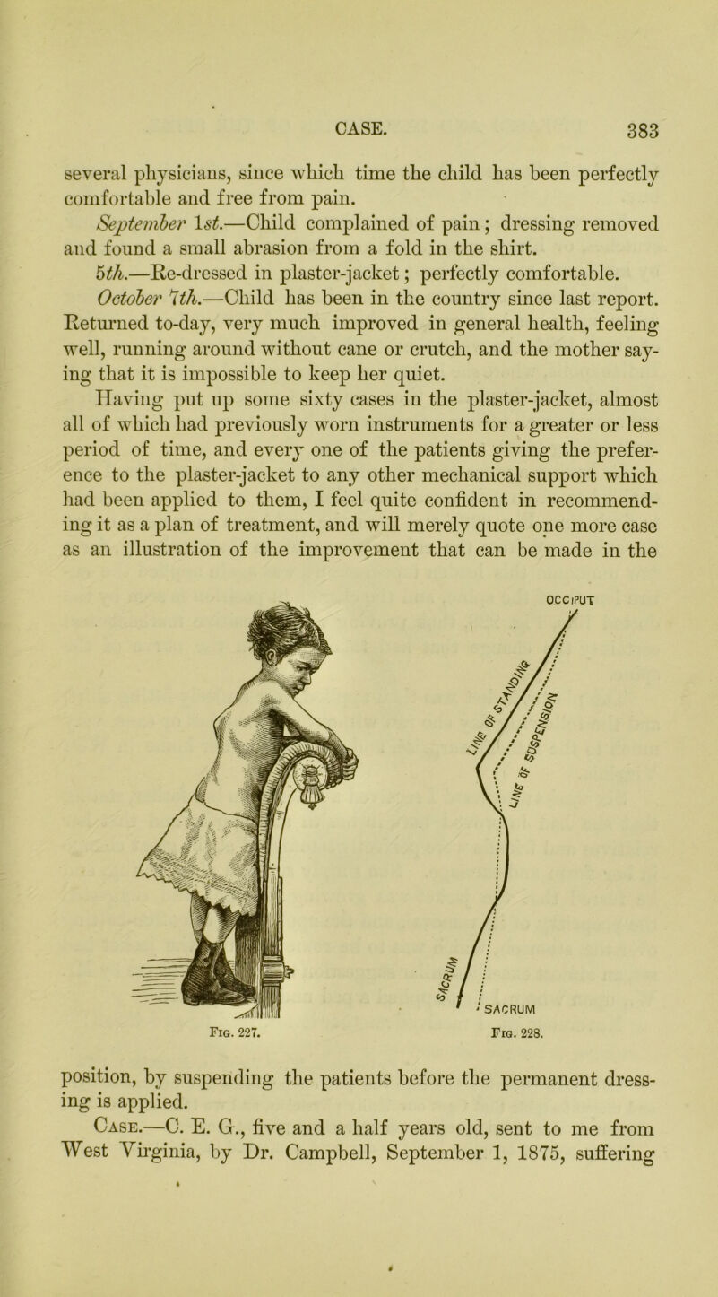 several physicians, since which time the child has been perfectly comfortable and free from pain. September 1st.—Child complained of pain; dressing removed and found a small abrasion from a fold in the shirt. 5th.—Re-dressed in plaster-jacket; perfectly comfortable. October 7th.—Child has been in the country since last report. Returned to-day, very much improved in general health, feeling well, running around without cane or crutch, and the mother say- ing that it is impossible to keep her quiet. Having put up some sixty cases in the plaster-jacket, almost all of which had previously worn instruments for a greater or less period of time, and every one of the patients giving the prefer- ence to the plaster-jacket to any other mechanical support which had been applied to them, I feel quite confident in recommend- ing it as a plan of treatment, and will merely quote one more case as an illustration of the improvement that can be made in the Fig. 227. OCCIPUT position, by suspending the patients before the permanent dress- ing is applied. Case.—C. E. G., five and a half years old, sent to me from West Virginia, by Dr. Campbell, September 1, 1875, suffering