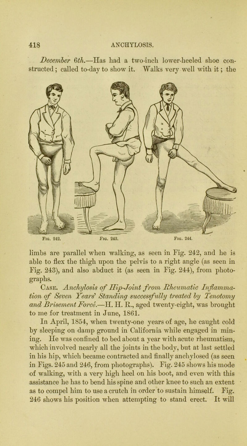 limbs are parallel when walking, as seen in Fig. 242, and he is able to flex the thigh upon the pelvis to a right angle (as seen in Fig. 243), and also abduct it (as seen in Fig. 244), from photo- graphs. Case. Anchylosis of Ilip-Joint from Rheumatic Inflamma- tion of Seven Years'1 Standing successfully treated by Tenotomy and Brisement Force.—H. H. R., aged twenty-eight, was brought to me for treatment in June, 1861. In April, 1854, when twenty-one years of age, he caught cold by sleeping on damp ground in California while engaged in min- ing. lie was confined to bed about a year with acute rheumatism, which involved nearly all the joints in the body, but at last settled in his hip, which became contracted and finally anchylosed (as seen in Figs. 245 and 246, from photographs). Fig. 245 shows his mode of walking, with a very high heel on his boot, and even with this assistance he has to bend his spine and other knee to such an extent as to compel him to use a crutch in order to sustain himself. Fig. 246 shows his position when attempting to stand erect. It will December 6th.—Has had a two-inch lower-heeled shoe con- structed; called to-day to show it. Walks very well with it; the Fig. 242. Fig. 243. Fig. 244.