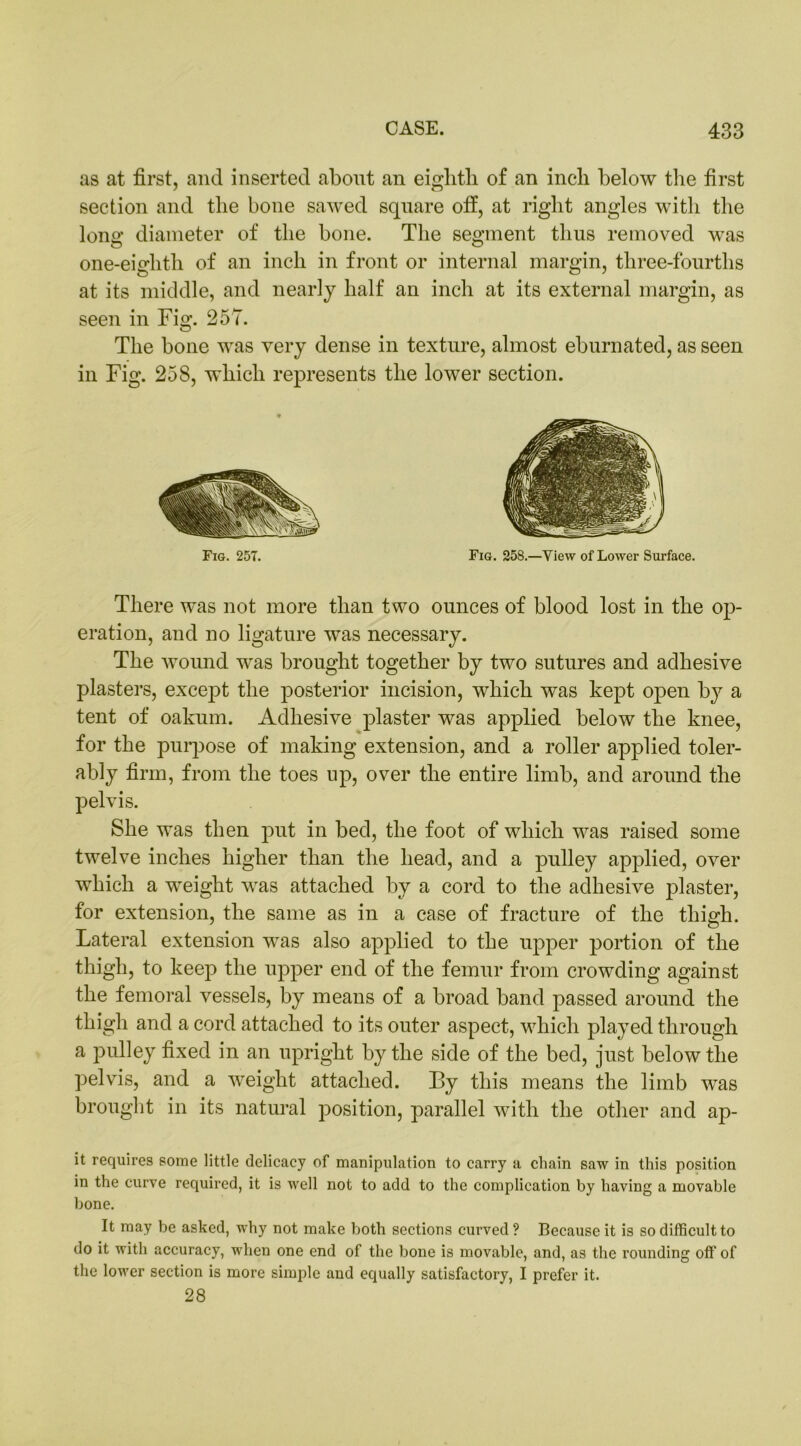 as at first, and inserted about an eighth of an inch below the first section and the bone sawed square off, at right angles witli the long diameter of the bone. The segment thus removed was one-eighth of an inch in front or internal margin, three-fourths at its middle, and nearly half an inch at its external margin, as seen in Fig. 257. The bone was very dense in texture, almost eburnated, as seen in Fig. 258, which represents the lower section. Fig. 258.—View of Lower Surface. Fig. 257. There was not more than two ounces of blood lost in the op- eration, and no ligature was necessary. The wound was brought together by two sutures and adhesive plasters, except the posterior incision, which was kept open by a tent of oakum. Adhesive plaster was applied below the knee, for the purpose of making extension, and a roller applied toler- ably firm, from the toes up, over the entire limb, and around the pelvis. She was then put in bed, the foot of which was raised some twelve inches higher than the head, and a pulley applied, over which a weight was attached by a cord to the adhesive plaster, for extension, the same as in a case of fracture of the thigh. Lateral extension was also applied to the upper portion of the thigh, to keep the upper end of the femur from crowding against the femoral vessels, by means of a broad band passed around the thigh and a cord attached to its outer aspect, which played through a pulley fixed in an upright by the side of the bed, just below the pelvis, and a weight attached. By this means the limb was brought in its natural position, parallel with the other and ap- it requires some little delicacy of manipulation to carry a chain saw in this position in the curve required, it is well not to add to the complication by having a movable bone. It may be asked, why not make both sections curved? Because it is so difficult to do it with accuracy, when one end of the bone is movable, and, as the rounding off of the lower section is more simple and equally satisfactory, I prefer it. 28