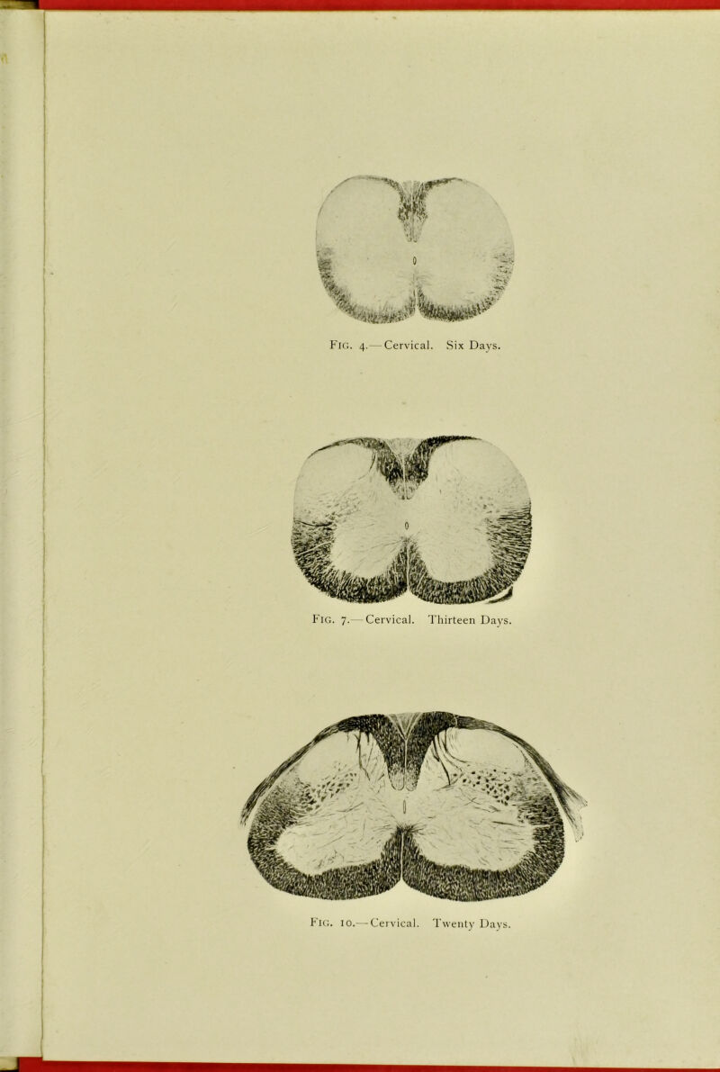 I i t *.1 % 'Cv? ,.i;f • ^s- Fig. 4.— Cervical. Six Days. Fig. 7.— Cervical. Thirteen Days.