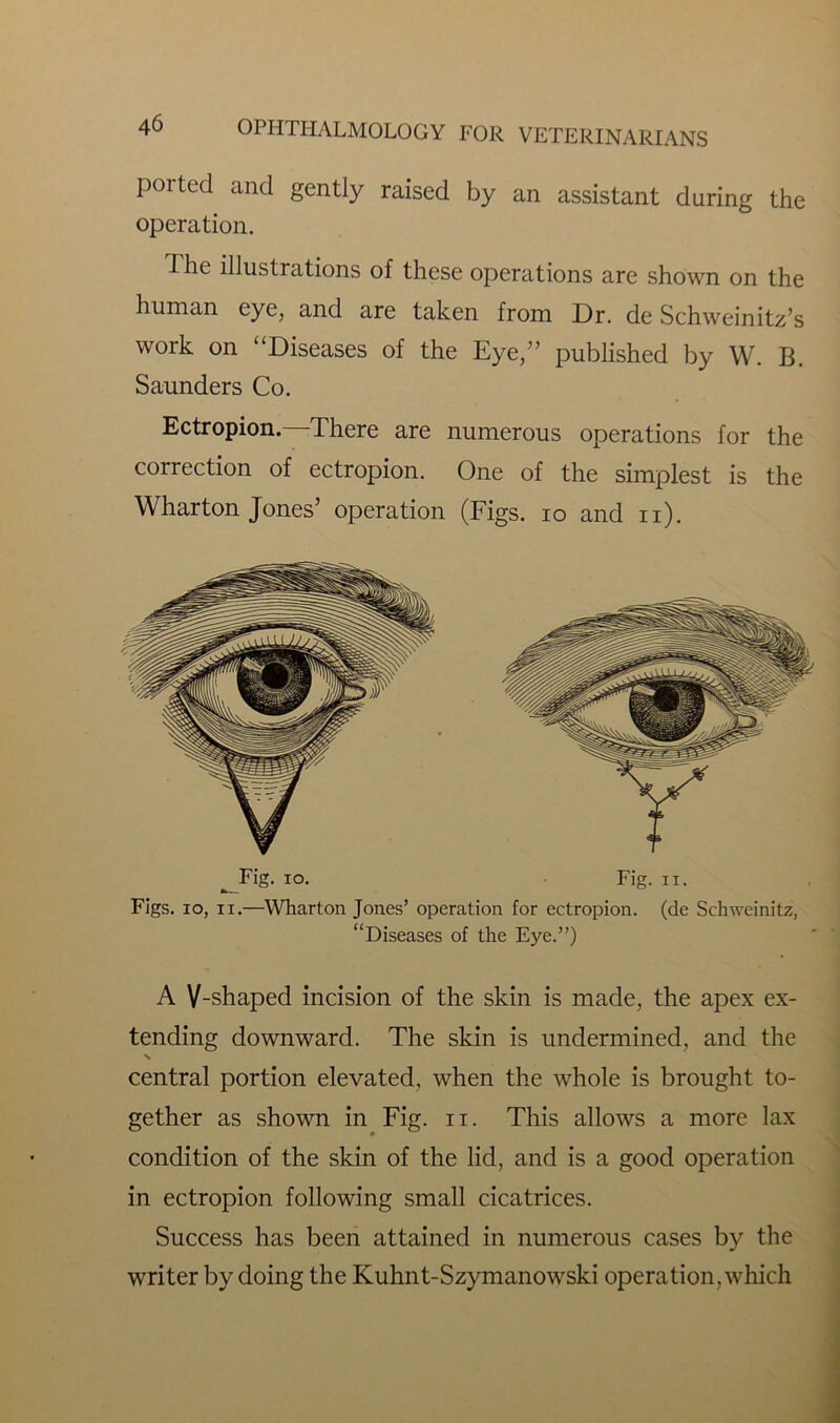 poitecl and gently raised by an assistant during the operation. I he illustrations of these operations are shown on the human eye, and are taken from Dr. de Schweinitz’s work on “Diseases of the Eye,” published by W. B. Saunders Co. Ectropion.—There are numerous operations for the correction of ectropion. One of the simplest is the Wharton Jones’ operation (Figs, io and n). ^Fig. io. Fig. ii. Figs, io, ii.—Wharton Jones’ operation for ectropion, (de Schweinitz, “Diseases of the Eye.”) A V-shaped incision of the skin is made, the apex ex- tending downward. The skin is undermined, and the central portion elevated, when the whole is brought to- gether as shown in Fig. ii. This allows a more lax condition of the skin of the lid, and is a good operation in ectropion following small cicatrices. Success has been attained in numerous cases by the writer by doing the Kuhnt-Szymanowski operation, which