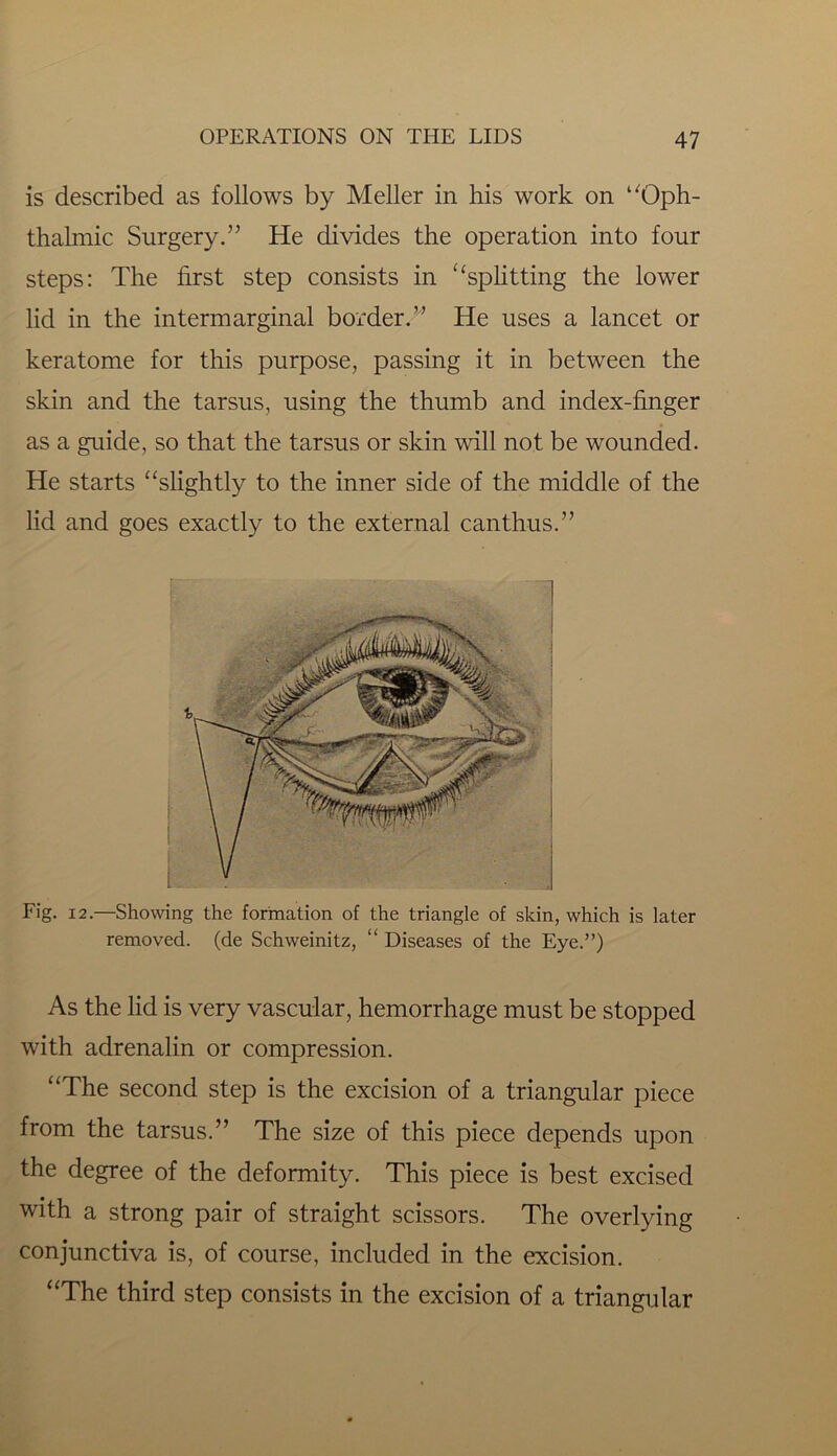 is described as follows by Meller in his work on “Oph- thalmic Surgery.” He divides the operation into four steps: The first step consists in “splitting the lower lid in the intermarginal border.” He uses a lancet or keratome for this purpose, passing it in between the skin and the tarsus, using the thumb and index-finger as a guide, so that the tarsus or skin will not be wounded. He starts “slightly to the inner side of the middle of the lid and goes exactly to the external can thus.” Fig. 12.—Showing the formation of the triangle of skin, which is later removed, (de Schweinitz, “ Diseases of the Eye.”) As the lid is very vascular, hemorrhage must be stopped with adrenalin or compression. “The second step is the excision of a triangular piece from the tarsus.” The size of this piece depends upon the degree of the deformity. This piece is best excised with a strong pair of straight scissors. The overlying conjunctiva is, of course, included in the excision. “The third step consists in the excision of a triangular