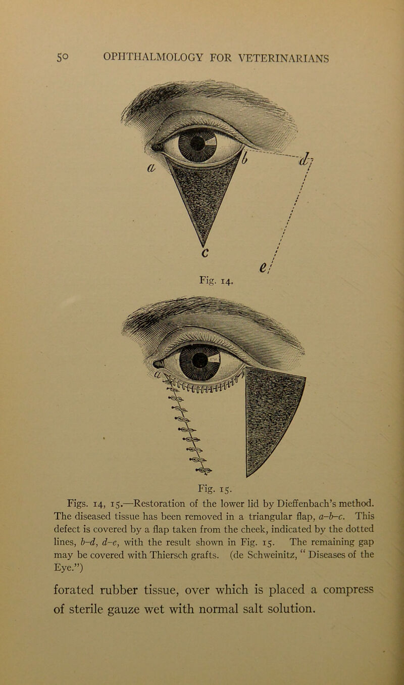 Fig- 15- Figs. 14, 15.—Restoration of the lower lid by Dieffenbach’s method. The diseased tissue has been removed in a triangular flap, a-b-c. This defect is covered by a flap taken from the cheek, indicated by the dotted lines, b-d, d-e, with the result shown in Fig. 15. The remaining gap may be covered with Thiersch grafts, (de Schweinitz, “ Diseases of the Eye.”) forated rubber tissue, over which is placed a compress of sterile gauze wet with normal salt solution.