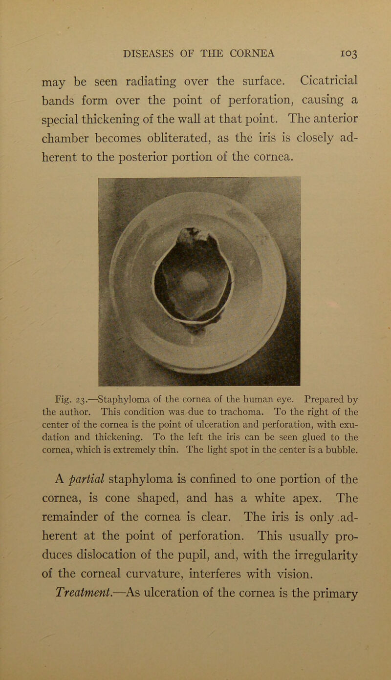 may be seen radiating over the surface. Cicatricial bands form over the point of perforation, causing a special thickening of the wall at that point. The anterior chamber becomes obliterated, as the iris is closely ad- herent to the posterior portion of the cornea. Fig. 23.—Staphyloma of the cornea of the human eye. Prepared by the author. This condition was due to trachoma. To the right of the center of the cornea is the point of ulceration and perforation, with exu- dation and thickening. To the left the iris can be seen glued to the cornea, which is extremely thin. The light spot in the center is a bubble. A partial staphyloma is confined to one portion of the cornea, is cone shaped, and has a white apex. The remainder of the cornea is clear. The iris is only ad- herent at the point of perforation. This usually pro- duces dislocation of the pupil, and, with the irregularity of the corneal curvature, interferes with vision. Treatment.—As ulceration of the cornea is the primary