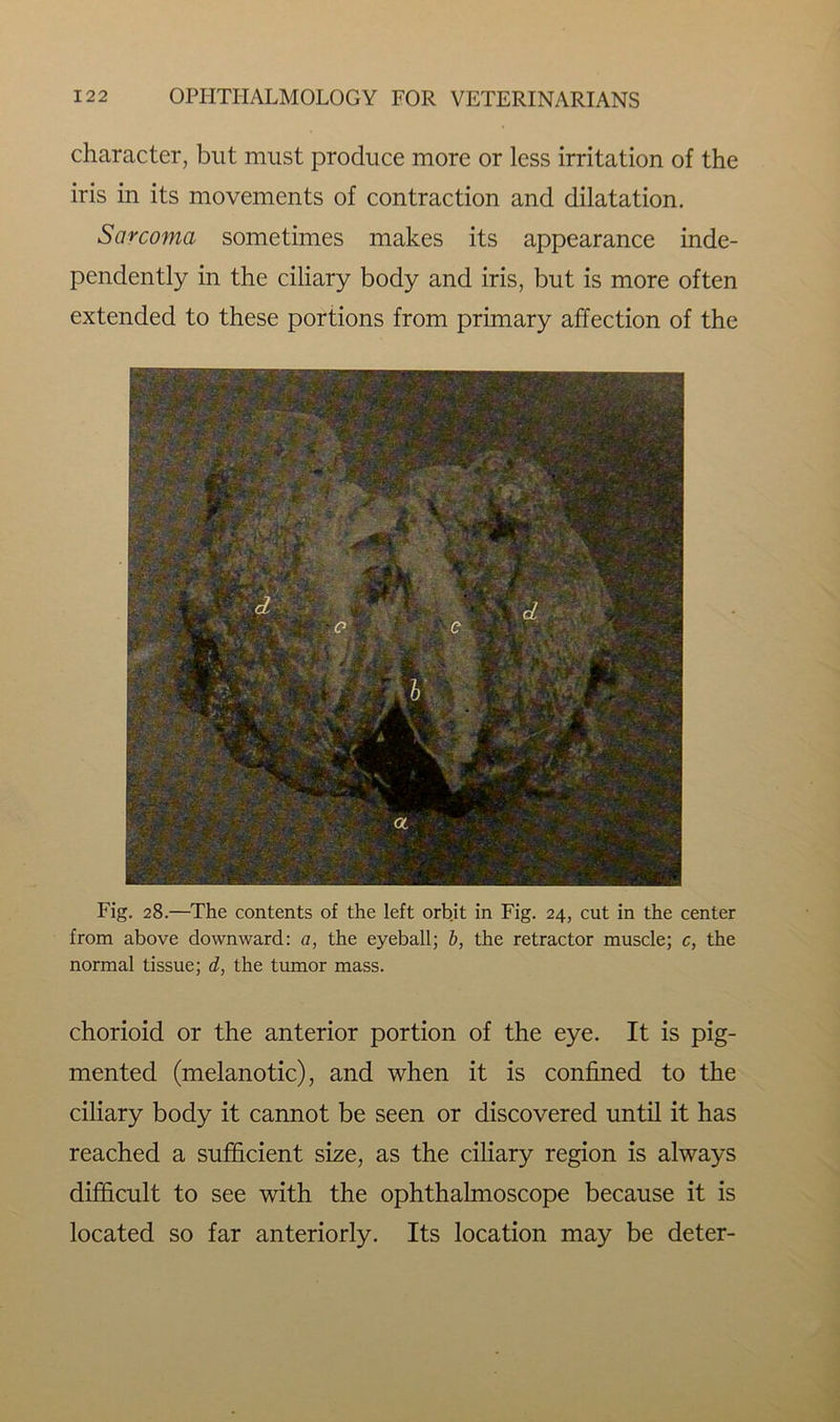 character, but must produce more or less irritation of the iris in its movements of contraction and dilatation. Sarcoma sometimes makes its appearance inde- pendently in the ciliary body and iris, but is more often extended to these portions from primary affection of the Fig. 28.—The contents of the left orbit in Fig. 24, cut in the center from above downward: a, the eyeball; b, the retractor muscle; c, the normal tissue; d, the tumor mass. chorioid or the anterior portion of the eye. It is pig- mented (melanotic), and when it is confined to the ciliary body it cannot be seen or discovered until it has reached a sufficient size, as the ciliary region is always difficult to see with the ophthalmoscope because it is located so far anteriorly. Its location may be deter-