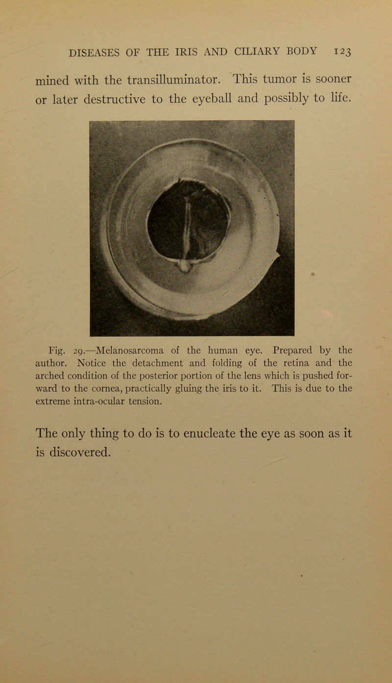 mined with the transilluminator. This tumor is sooner or later destructive to the eyeball and possibly to life. Fig. 29.—Melanosarcoma of the human eye. Prepared by the author. Notice the detachment and folding of the retina and the arched condition of the posterior portion of the lens which is pushed for- ward to the cornea, practically gluing the iris to it. This is due to the extreme intra-ocular tension. The only thing to do is to enucleate the eye as soon as it is discovered.