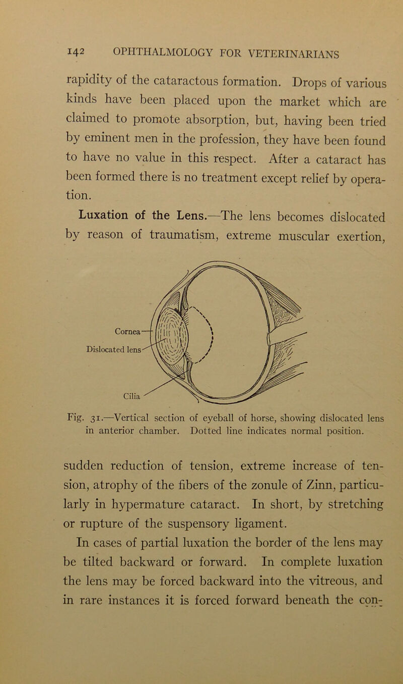 rapidity of the cataractous formation. Drops of various kinds have been placed upon the market which are claimed to promote absorption, but, having been tried by eminent men in the profession, they have been found to have no value in this respect. After a cataract has been formed there is no treatment except relief by opera- tion. Luxation of the Lens.—The lens becomes dislocated by reason of traumatism, extreme muscular exertion, Cornea Dislocated lens Cilia Fig. 31.—Vertical section of eyeball of horse, showing dislocated lens in anterior chamber. Dotted line indicates normal position. sudden reduction of tension, extreme increase of ten- sion, atrophy of the fibers of the zonule of Zinn, particu- larly in hypermature cataract. In short, by stretching or rupture of the suspensory ligament. In cases of partial luxation the border of the lens may be tilted backward or forward. In complete luxation the lens may be forced backward into the vitreous, and in rare instances it is forced forward beneath the con-