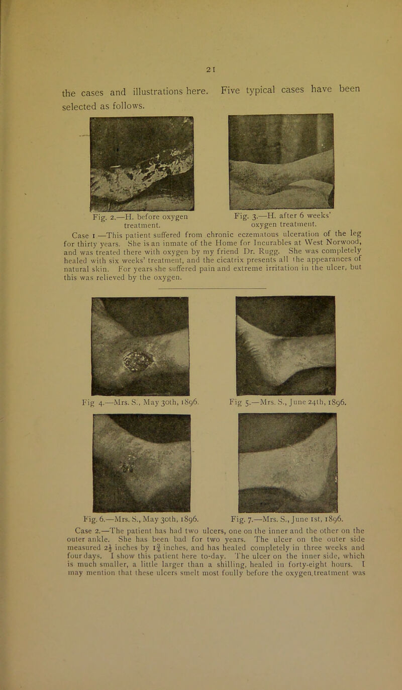 the cases and illustrations here. Five typical cases have been selected as follows. Fig. 2.—H. before oxygen Fig. 3.—H. after 6 weeks’ treatment. oxygen treatment. Case 1 —This patient suffered from chronic eczematous ulceration of the leg for thirty years. She is an inmate of the Home for Incurables at West Norwood, and was treated there with oxygen by my friend Dr. Rugg. She was completely healed with six weeks’ treatment, and the cicatrix presents all ihe appearances of natural skin. P'or years she suffered pain and extreme irritation in the ulcer, but this was relieved by the o.xygen. Fig 4.—Mrs. S., May 30th, 1896. F'g 5-—Mrs. S., June 24th, 1896. Fig. 6.—Mrs. S., May 30th, 1896. Fig. 7.—Mrs. S., June ist, 1896. Case 2.—The patient has had two ulcers, one on the inner and the other on the outer ankle. She has been bad for two years. The ulcer on the outer side measured 2J inches by ij inches, and has healed completely in three weeks and four days. I show this patient here to-day. The ulcer on the inner side, which is much smaller, a little larger than a shilling, healed in forty-eight hours. I may mention that these ulcers smelt most foully before the oxygen.treatment was