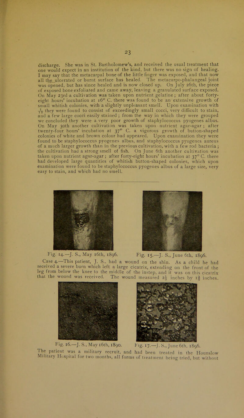 discharge. She was in St. Bartholomew’s, and received the usual treatment that one would expect in an institution of the kind, but there was no sign of healing. I may say that the metacarpal bone of the little finger was exposed, and that now all th,e_uIcerated or burnt surface has healed. The metacarpo-phalangeal joint was opened, but has since healed and is now closed up. On July 26th, the piece of exposed bone exfoliated and came away, leaving a granulated surface exposed. On May 23rd a cultivation was taken upon nutrient gelatine; after about forty- eight hours’ incubation at 16° C. there was found to be an extensive growth of small whitish colonies, with a slightly unpleasant smell. Upon examination with they were found to consist of exceedingly small cocci, very difficult to stain, and a few large cocci easily stained ; from the way in which they were grouped we concluded they were a very poor growth of staphylococcus pyogenes albus. On May 30th another cultivation was taken upon nutrient agar-agar ; after twenty-four hours’ incubation at 37° C. a vigorous growth of button-shaped colonies of white and brown colour had appeared. Upon examination they were found to be staphylococcus pyogenes albus, and staphylococcus p}'ogenes aureus of a much larger growth than in the previous cultivation, with a few rod bacteria; the cultivation had a strong smell of fish. On June 6th another cultivation was taken upon nutrient agar-agar; after forty-eight hours’ incubation at 37° C. there had developed large quantities of whitish button-shaped colonies, which upon examination were found to be staphylococcus pyogenes albus of a large size, very easy to stain, and which had no smell. Fig- 14-—J- S., May l6th, 1896. Fig. 15.—J. S., June 6th, 1896. Case 4.—This patient, J. S.. had a wound on the shin. As a child he had received a severe burn which left a large cicatrix, extending on the front of the leg from below the knee to the middle of the instep, and i'l was on this cicatrix that the wound was received. The wound measured 2g inches by inches. Fig. 16.—J. S., May l6th, 1890. Fig. 17.—J. S., June6th, 1896. The patient was a military recruit, and had been treated in the Hounslow Military Hospital for two months, all forms of tieatment being tried, but without