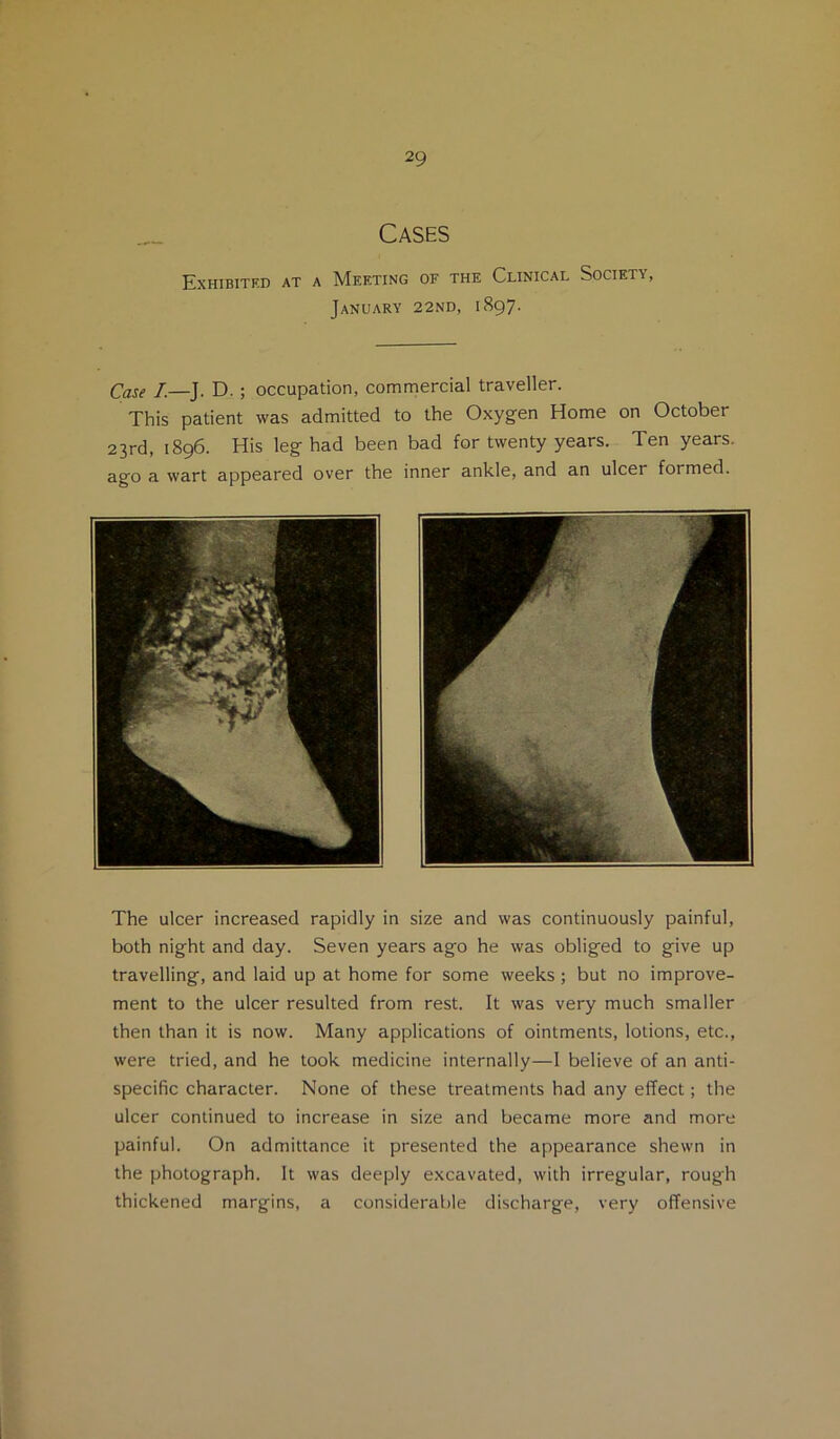 Cases Exhibitf.d at a Meeting of the Clinical Society, January 22nd, 1897. Case I.—J. D.; occupation, commercial traveller. This patient was admitted to the Oxygen Home on October 23rd, 1896. His leg had been bad for twenty years. Ten years, ago a wart appeared over the inner ankle, and an ulcer formed. The ulcer increased rapidly in size and was continuously painful, both night and day. Seven years ago he was obliged to give up travelling, and laid up at home for some weeks ; but no improve- ment to the ulcer resulted from rest. It was very much smaller then than it is now. Many applications of ointments, lotions, etc., were tried, and he took medicine internally—I believe of an anti- specific character. None of these treatments had any effect; the ulcer continued to increase in size and became more and more painful. On admittance it presented the appearance shewn in the photograph. It was deeply excavated, with irregular, rough thickened margins, a considerable discharge, very offensive