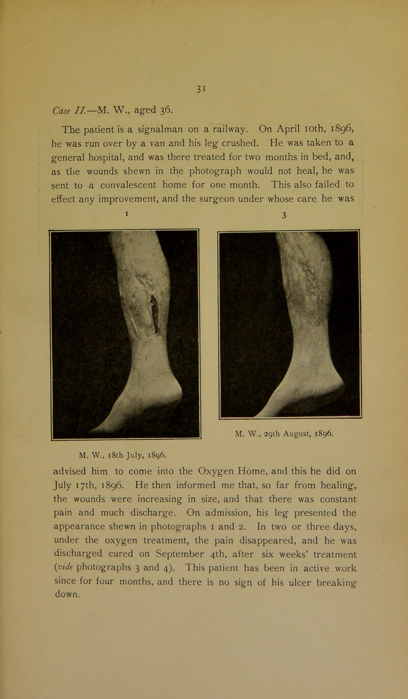 Case II.—M. W., aged 36. The patient is a signalman on a railway. On April lOth, 1896, he was run over by a van and his leg crushed. He was taken to a general hospital, and was there treated for two months in bed, and, as the wounds shewn in the photograph would not heal, he was sent to a convalescent home for one month. This also failed to effect any improvement, and the surgeon under whose care he was I 3 M. W., 29th August, 1896. M. W., i8th July, 1896. advised him to come into the Oxygen Home, and this he did on July 17th, 1896. He then informed me that, so far from healing, the wounds were increasing in size, and that there was constant pain and much discharge. On admission, his leg presented the appearance shewn in photographs i and 2. In two or three days, under the oxygen treatment, the pain disappeared, and he was discharged cured on September 4th, after six weeks’ treatment i^ide photographs 3 and 4). This patient has been in active work since for four months, and there is no sign of his ulcer breaking down.