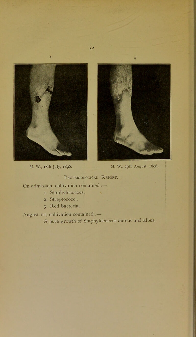 M. W., i8th July, 1896. M. W., 29th August, 1896. Bactfj<iological Report. On admission, cultivation contained :— 1. Staphylococcus. \ 2. Streptococci. 3 Rod bacteria. August 1st, cultivation contained :— A pure uruwth of Staphylococcus aureus and albus.