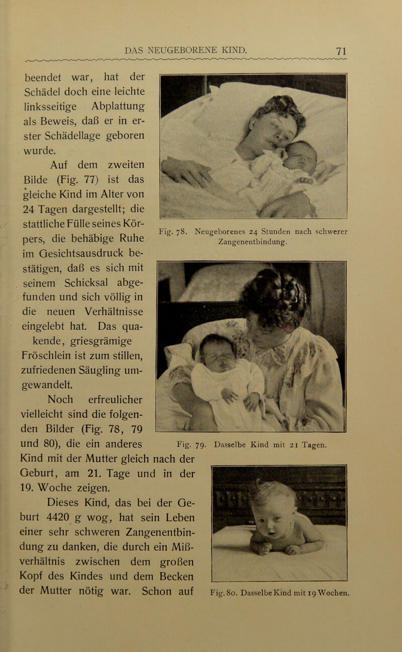 beendet war, hat der Schädel doch eine leichte linksseitige Abplattung als Beweis, daß er in er- ster Schädellage geboren wurde. Auf dem zweiten Bilde (Fig. 77) ist das gleiche Kind im Alter von 24 Tagen dargestellt; die stattliche Fülle seines Kör- 1-* r» u Fig. 78. Neugeborenes 24 Stunden nach schwerer pers, die behäbige Ruhe Zangenentbindung. im Gesichtsausdruck be- stätigen, daß es sich mit seinem Schicksal abge- funden und sich völlig in die neuen Verhältnisse eingelebt hat. Das qua- kende, griesgrämige Fröschlein ist zum stillen, zufriedenen Säugling um- gewandelt. Noch erfreulicher vielleicht sind die folgen- den Bilder (Fig. 78, 79 und 80), die ein anderes Fig. 79. Dasselbe Kind mit 21 Tagen. Kind mit der Mutter gleich nach der Geburt, am 21. Tage und in der 19. Woche zeigen. Dieses Kind, das bei der Ge- burt 4420 g wog, hat sein Leben einer sehr schweren Zangenentbin- dung zu danken, die durch ein Miß- verhältnis zwischen dem großen Kopf des Kindes und dem Becken der Mutter nötig war. Schon auf Fig. 8o. Dasselbe Kind mit 19 Wochen.