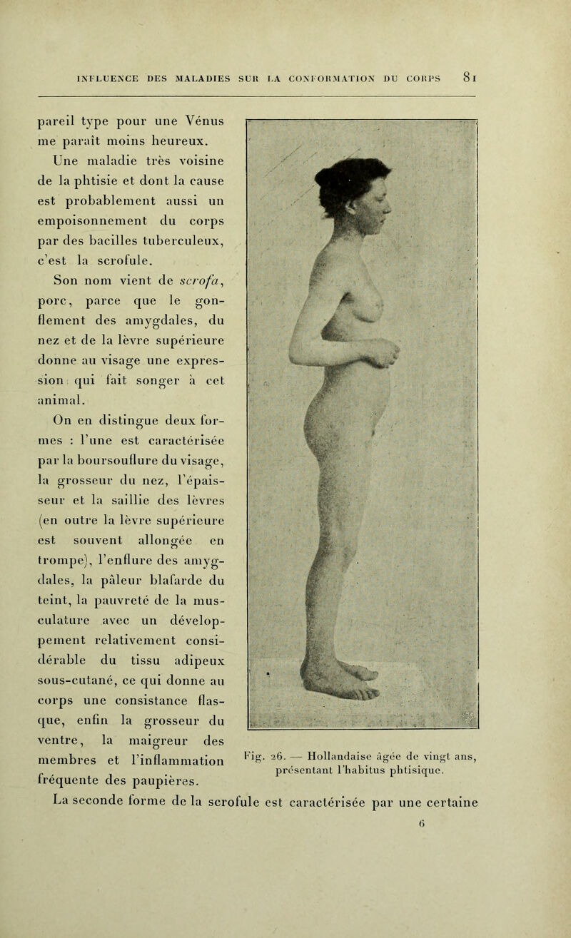 pareil type pour une Vénus me paraît moins heureux. Une maladie très voisine de la phtisie et dont la cause est probablement aussi un empoisonnement du corps par des bacilles tuberculeux, c’est la scrofule. Son nom vient de scrofa, porc, parce que le gon- flement des amygdales, du nez et de la lèvre supérieure donne au visage une expres- sion qui fait songer à cet animal. On en distingue deux for- mes : l’une est caractérisée par la boursouflure du visage, la grosseur du nez, l’épais- seur et la saillie des lèvres (en outre la lèvre supérieure est souvent allongée en O trompe), l’enflure des amyg- dales, la pâleur blafarde du teint, la pauvreté de la mus- culature avec un dévelop- pement relativement consi- dérable du tissu adipeux sous-cutané, ce qui donne au corps une consistance flas- que, enfin la grosseur du ventre, la maigreur des membres et l’inflammation fréquente des paupières. Fig. 26. — Hollandaise âgée de vingt ans, présentant l’habitus phtisique. La seconde forme de la scrofule est caractérisée par une certaine 6