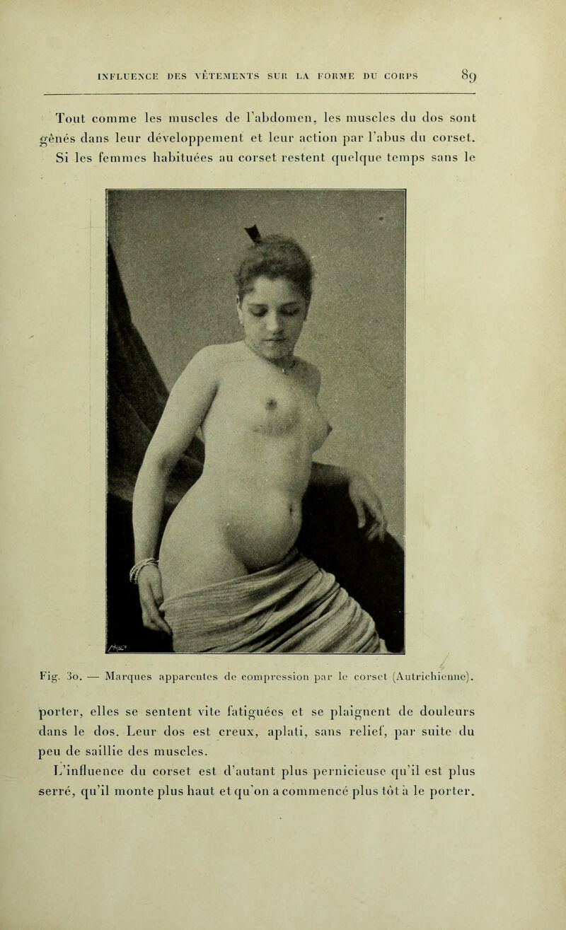 Tout comme les muscles de l’abdomen, les muscles du dos sont gênés dans leur développement et leur action par l’abus du corset. Si les femmes habituées au corset restent quelque temps sans le Fig. 3o. — Marques apparentes de compression par le corset (Autrichienne). porter, elles se sentent vite fatiguées et se plaignent de douleurs dans le dos. Leur dos est creux, aplati, saus relief, par suite du peu de saillie des muscles. L’influence du corset est d’autant plus pernicieuse qu’il est plus serré, qu’il monte plus haut et qu'on a commencé plus tôt à le porter.