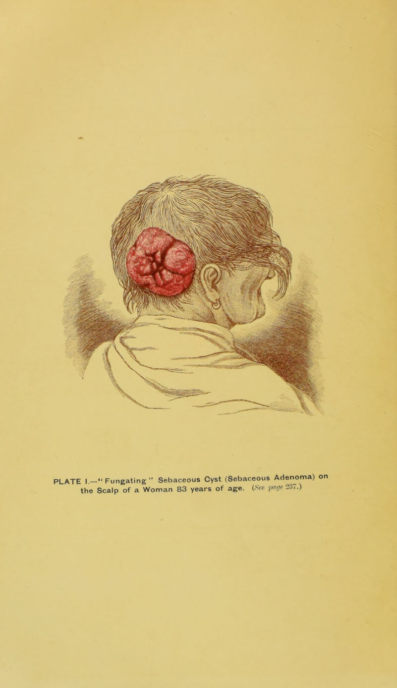 PLATE I —“ Fungating ” Sebaceous Cyst (Sebaceous Adenoma) on the Scalp of a Woman 83 years of age. (.See page 237.)