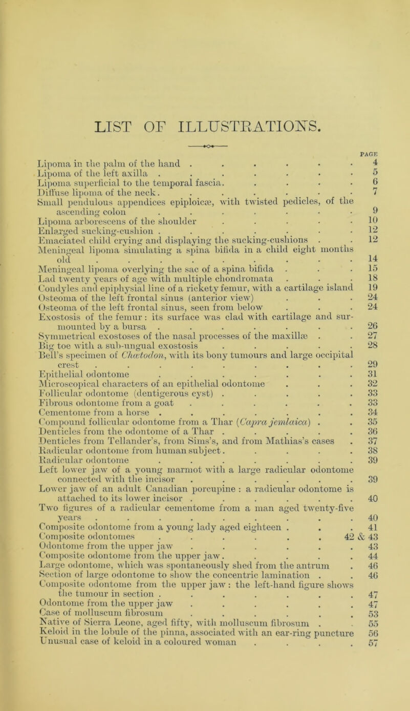 LIST OF ILLUSTRATIONS »o« PAGE Lipoma in the palm of the hand 4 Lipoma of the left axilla 5 Lipoma superficial to the temporal fascia. . . . . G Diffuse lipoma of the neck. . . . . *7 Small pendulous appendices epiploicte, with twisted pedicles, of the ascending colon ....... 9 Lipoma arborescens of the shoulder . . • • .10 Enlarged sucking-cushion . . . . • • .12 Emaciated child crying and displaying the sucking-cushions . . 12 Meningeal lipoma simulating a spina bifida in a child eight months old ...... ... 14 Meningeal lipoma overlying the sac of a spina bifida . . .15 Lad twenty years of age with multiple chondromata . . .18 Condyles and epiphysial line of a rickety femur, with a cartilage island 19 Osteoma of the left frontal sinus (anterior view) . . .24 Osteoma of the left frontal sinus, seen from below . . .24 Exostosis of the femur: its surface was clad with cartilage and sur- mounted by a bursa . . . . . . .26 Symmetrical exostoses of the nasal processes of the maxillfe . . 27 Big toe with a sub-ungual exostosis . . . . .28 Bell’s specimen of Chcctodon, with its bony tumours and large occipital crest ......... 29 Epithelial odontome . . . . . . .31 Microscopical characters of an epithelial odontome . . .32 Follicular odontome (dentigerous cyst) . . . . .33 Fibrous odontome from a goat . . . . . .33 Cementome from a horse ....... 34 Compound follicular odontome from a Thar (Capra jemlaica) . . 35 Denticles from the odontome of a Thar . . . . .36 Denticles from Tellander’s, from Sims’s, and from Mathias’s cases . 37 Radicular odontome from human subject. . . . .38 Radicular odontome . . . . . . .39 Left lower jaw of a young marmot with a large radicular odontome connected with the incisor . . . . . .39 Lower jaw of an adult Canadian porcupine : a radicular odontome is attached to its lower incisor . . . . . .40 Two figures of a radicular cementome from a man aged twenty-five years ......... 40 Composite odontome from a young lady aged eighteen . . .41 Composite odontomes . . . . . . 42 & 43 Odontome from the upper jaw . . . . . .43 Composite odontome from the upper jaw. . . . .44 Large odontome, which was spontaneously shed from the antrum . 46 Section of large odontome to show the concentric lamination . . 46 Composite odontome from the upper jaw: the left-hand figure shows the tumour in section . . . . . .47 Odontome from the upper jaw . . . . . .47 Case of molluscum fibrosum . . . . . .53 Native of Sierra Leone, aged fifty, with molluscum fibrosum . 55 Keloid in the lobule of the pinna, associated with an ear-ring puncture 56 Unusual case of keloid in a coloured woman . . . .57