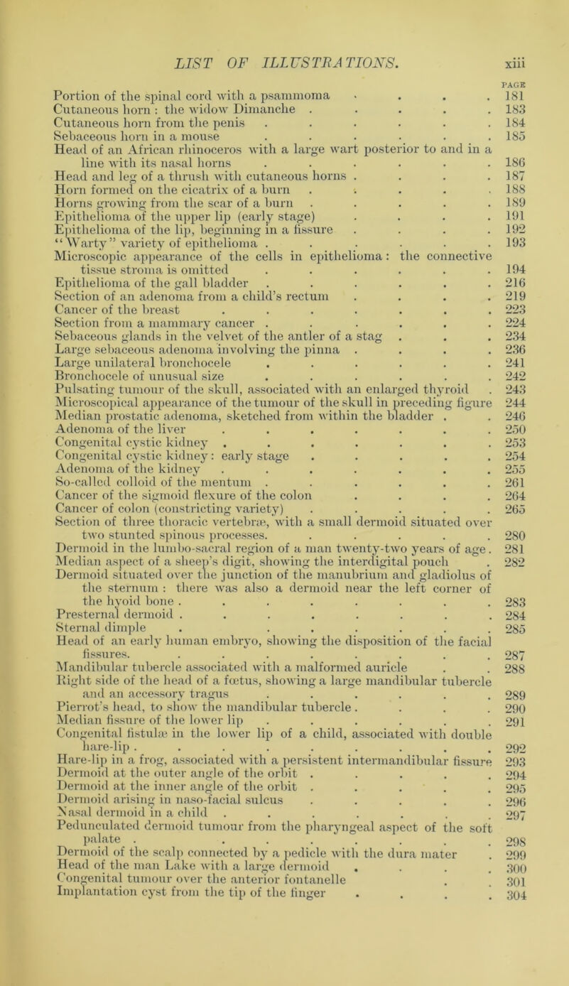 Portion of the spinal cord with a psammoma > Cutaneous horn : the widow Dimanche ..... Cutaneous horn from the penis ...... Sebaceous horn in a mouse ...... Head of an African rhinoceros with a large wart posterior to and in a line with its nasal horns ...... Head and leg of a thrush with cutaneous horns .... Horn formed on the cicatrix of a bum ...... Horns growing from the scar of a burn ..... Epithelioma of the upper lip (early stage) .... Epithelioma of the lip, beginning in a fissure .... “Warty” variety of epithelioma ...... Microscopic appearance of the cells in epithelioma: the connective tissue stroma is omitted ...... Epithelioma of the gall bladder ...... Section of an adenoma from a child’s rectum .... Cancer of the breast ....... Section from a mammary cancer ...... Sebaceous glands in the velvet of the antler of a stag Large sebaceous adenoma involving the pinna .... Large unilateral bronchocele ...... Bronchocele of unusual size ...... Pulsating tumour of the skull, associated with an enlarged thyroid Microscopical appearance of the tumour of the skull in preceding figure Median prostatic adenoma, sketched from within the bladder . Adenoma of the liver ....... Congenital cystic kidney ....... Congenital cystic kidney: early stage ..... Adenoma of the kidney ....... So-called colloid of the mentum ...... Cancer of the sigmoid flexure of the colon .... Cancer of colon (constricting variety) ..... Section of three thoracic vertebrae, with a small dermoid situated over two stunted spinous processes. ..... Dermoid in the lumbo sacral region of a man twenty-two years of age. Median aspect of a sheep’s digit, showing the interdigital pouch Dermoid situated over the junction of the manubrium and gladiolus of the sternum : there was also a dermoid near the left corner of the hyoid bone ........ Presternal dermoid ........ Sternal dimple . ...... Head of an early human embryo, showing the disposition of the facial fissures. ........ Mandibular tubercle associated with a malformed auricle Right side of the head of a foetus, showing a large mandibular tubercle and an accessory tragus ...... Pierrot’s head, to show the mandibular tubercle .... Median fissure of the lower lip Congenital fistula; in the lower lip of a child, associated with double hare-lip ......... Hare-lip in a frog, associated with a persistent intermandibular fissure Dermoid at the outer angle of the orbit ..... Dermoid at the inner angle of the orbit ..... Dermoid arising in naso-facial sulcus ..... Nasal dermoid in a child ...... Pedunculated dermoid tumour from the pharyngeal aspect of the soft palate . ....... Dermoid of the scalp connected by a pedicle with the dura mater Head of the man Lake with a large dermoid .... Congenital tumour over the anterior fontanelle Implantation cyst from the tip of the finger . . . ’ PAGE 181 183 184 1S5 186 187 188 189 191 192 193 194 216 219 223 224 234 236 241 242 243 244 246 250 253 254 255 261 264 265 280 281 2S2 283 284 285 287 288 289 290 291 292 293 294 295 296 297 29S 299 300 301 304