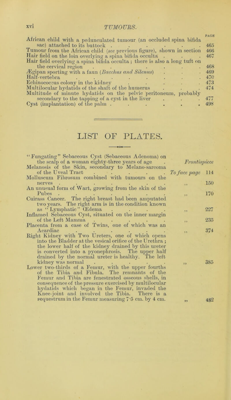 African child with a pedunculated tumour (an occluded spina bifida sac) attached to its buttock ...... Tumour from the African child (see previous figure), shown in section Hair field on the loin overlying a spina bifida occulta . Hair field overlying a spina bifida occulta ; there is also a long tuft on the cervical region . . .... vEgipan sporting with a faun (Bacchus and Silenus) Half-vertebra ........ Echinococcus colony in the kidney ..... Multilocular hydatids of the shaft of the humerus Multitude of minute hydatids on the pelvic peritoneum, probably secondary to the tapping of a cyst in the liver Cyst (implantation) of the palm ...... PAGE 465 466 467 468 469 470 473 474 477 498 LIST OF PLATES. “Fungating” Sebaceous Cyst (Sebaceous Adenoma) on the scalp of a woman eighty-three years of age . Frontispiece Melanosis of the Skin, secondary to Melano-sarcoma of the Uveal Tract ..... To face page 114 Molluscum Fibrosum combined with tumours on the nerves . . . . . . . ,, 150 An unusual form of Wart, growing from the skin of the Pubes . . . . . . . ,, 170 Cuirass Cancer. The right breast had been amputated two years. The right arm is in the condition known as ‘ ‘ Lymphatic ” (Edema . . . . ,, 227 Inflamed Sebaceous Cyst, situated on the inner margin of the Left Mamma . . . . . ,, 235 Placenta from a case of Twins, one of which was an Acardiac . . . . . . ,, 374 Right Kidney with Two Ureters, one of which opens into the Bladder at the vesical orifice of the Urethra ; the lower half of the kidney drained by this ureter is converted into a pyonephrosis. The upper half drained by the normal ureter is healthy. The left kidney was normal . . . . . ,, 3S5 Lower two-thirds of a Femur, with the upper fourths of the Tibia and Fibula. The remnants of the Femur and Tibia are fenestrated osseous shells, in consequence of the pressure exercised by multilocular hydatids which began in the Femur, invaded the Knee-joint and involved the Tibia. There is a sequestrum in the Femur measuring 7'5 cm. by 4 cm. 482