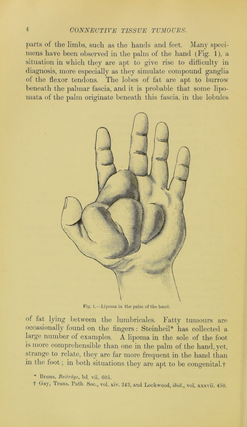 parts of the limbs, such as the hands and feet. Many speci- mens have been observed in the palm of the hand (Fig. 1), a situation in which they are apt to give rise to difficulty in diagnosis, more especially as they simulate compound ganglia of the flexor tendons. The lobes of fat are apt to burrow beneath the palmar fascia, and it is probable that some lipo- mata of the palm originate beneath this fascia, in the lobules Fig. 1.—Lipoma in tlie palm of the hand. of fat lying between the hunbricales. Fatty tumours are occasionally found on the fingers : Steinheil* has collected a large number of examples. A lipoma in the sole of the foot is more comprehensible than one in the palm of the hand, yet, strange to relate, they are far more frequent in the hand than in the toot; in both situations they are apt to be congenital.f * Bruns, Beitrage, bd. vii. 605. t La}, Piuns. 1 ath. Soc., vol. xiv. 243, and Lockwood, ibid., vol. xxxvii. 450.