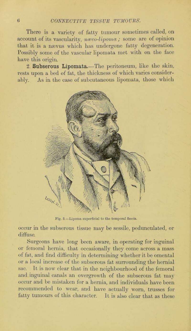 There is a variety of fatty tumour sometimes called, on account of its vascularity, ncevo-li'poma ; some are ot opinion that it is a nievus which has undergone fatty degeneration. Possibly some of the vascular lipomata met with on the face have this origin. 2, Subserous Lipomata.—The peritoneum, like the skin, rests upon a bed of fat, the thickness of which varies consider- ably. As in the case of subcutaneous lipomata, those which occur in the subserous tissue may be sessile, pedunculated, or diffuse. Surgeons have long been aware, in operating for inguinal or femoral hernia, that occasionally they come across a mass of fat, and find difficulty in determining whether it be omental or a local increase of the subserous fat surrounding the hernial sac. It is now clear that in the neighbourhood of the femoral and inguinal canals an overgrowth of the subserous fat may occur and be mistaken for a hernia, and individuals have been recommended to wear, and have actually worn, trusses for fatty tumours of this character. It is also clear that as these