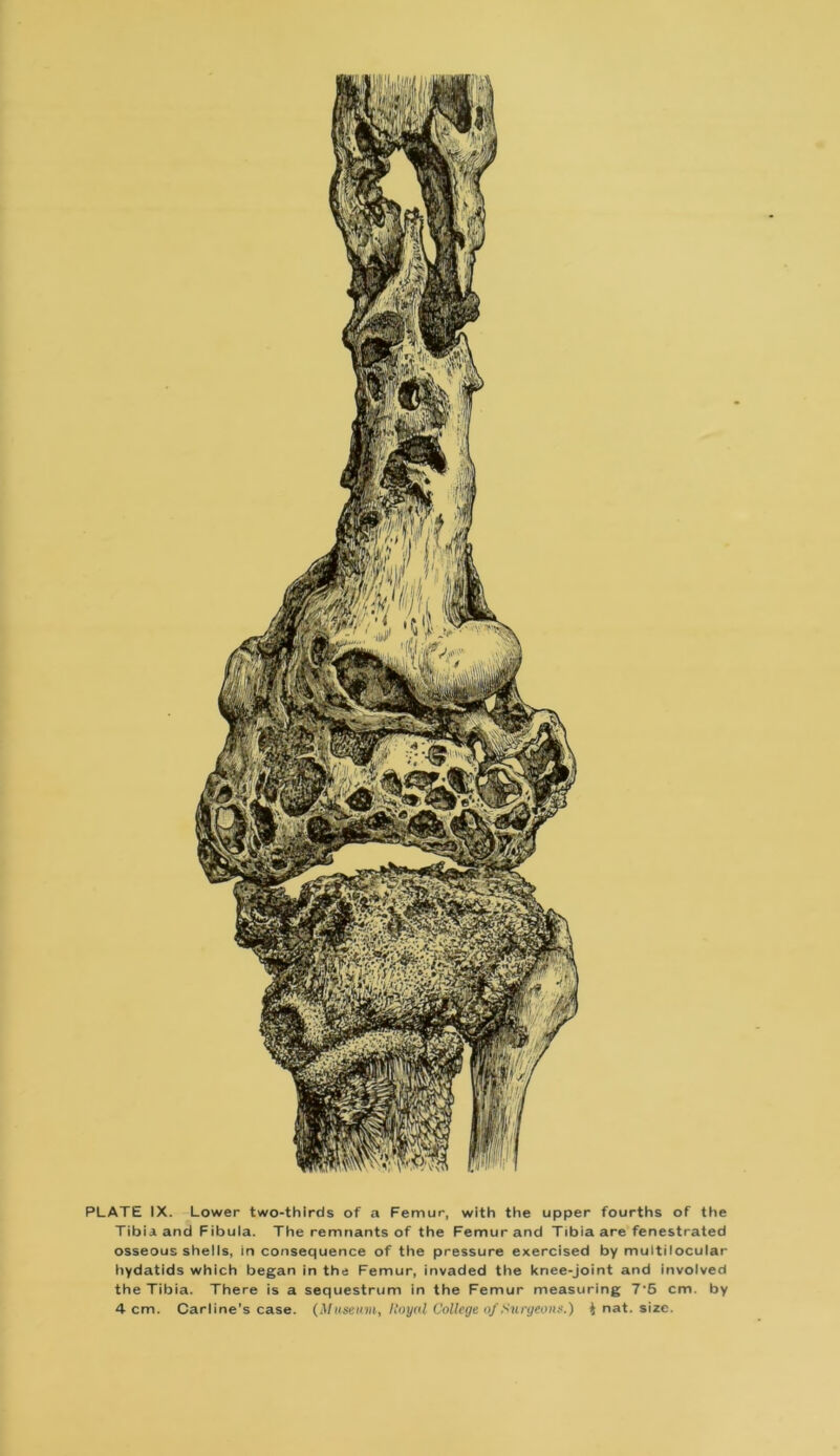 PLATE IX. Lower two-thirds of a Femur, with the upper fourths of the Tibia and Fibula. The remnants of the Femur and Tibia are fenestrated osseous shells, inconsequence of the pressure exercised by multilocular hydatids which began in the Femur, invaded the kriee-joint and involved the Tibia. There is a sequestrum in the Femur measuring 7'5 cm. by 4 cm. Carline's case. (Museum, Hoyal College of Surgeons.) i nat. size.